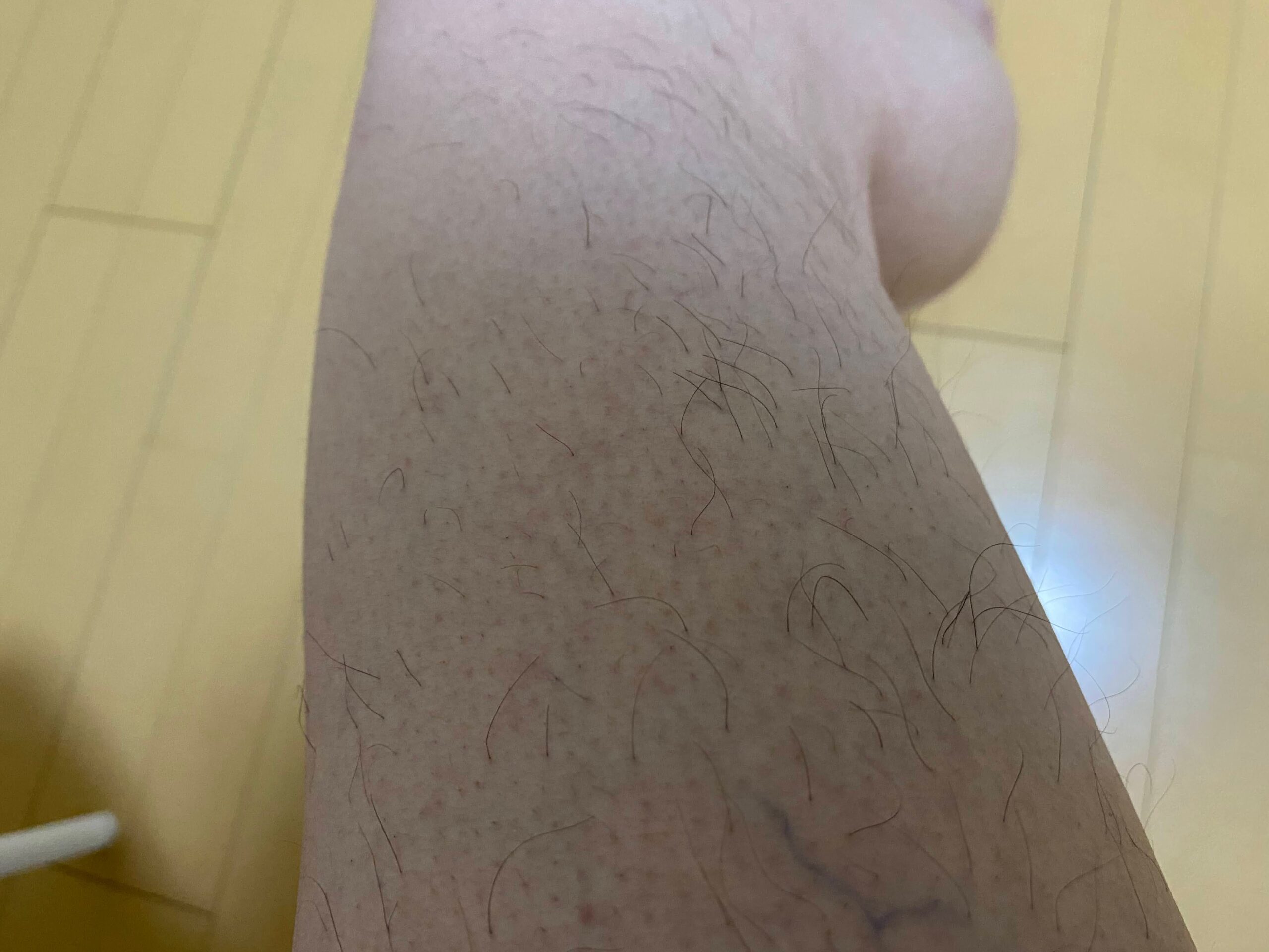 男の全身脱毛効果