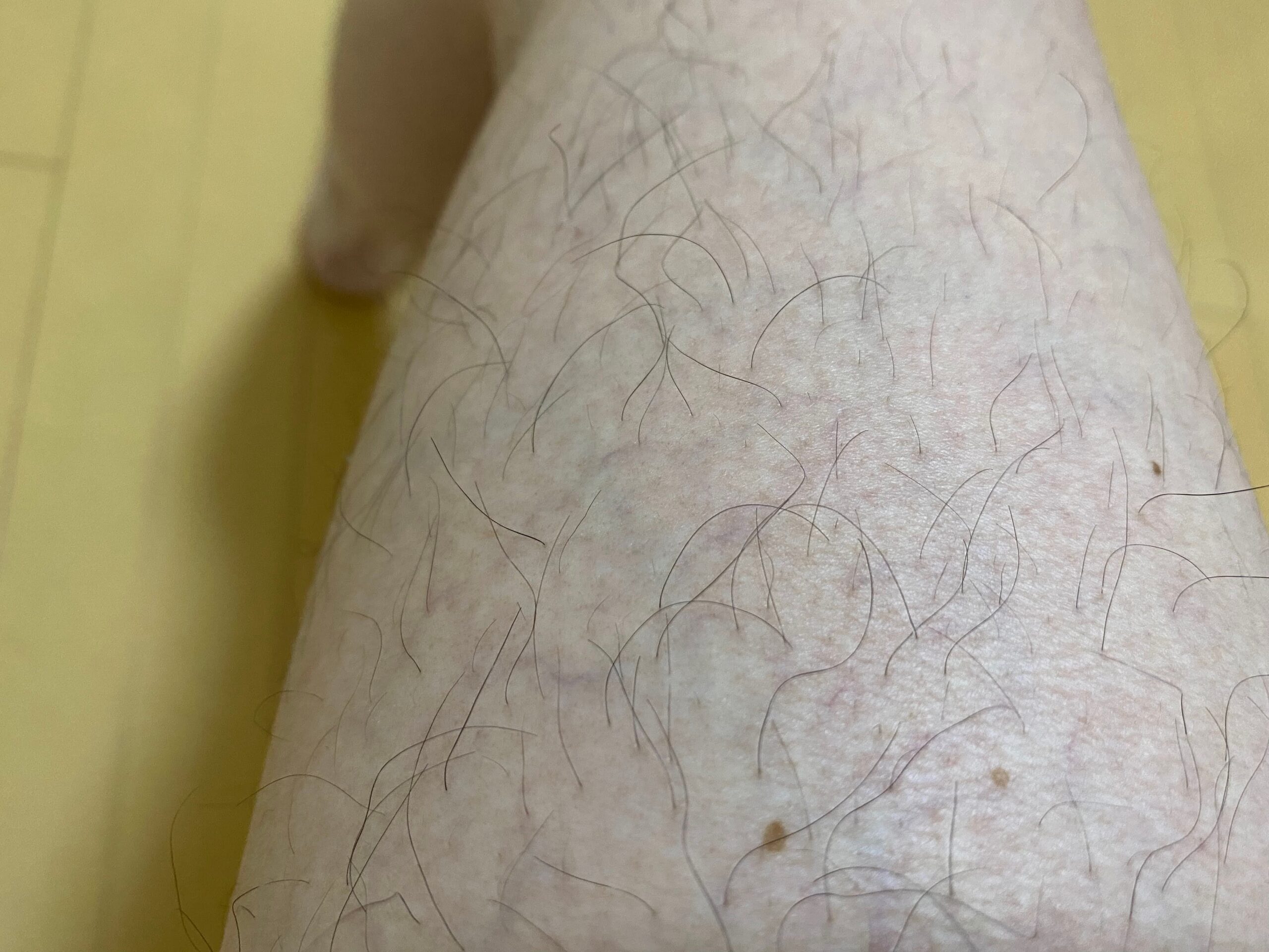 男の全身脱毛効果