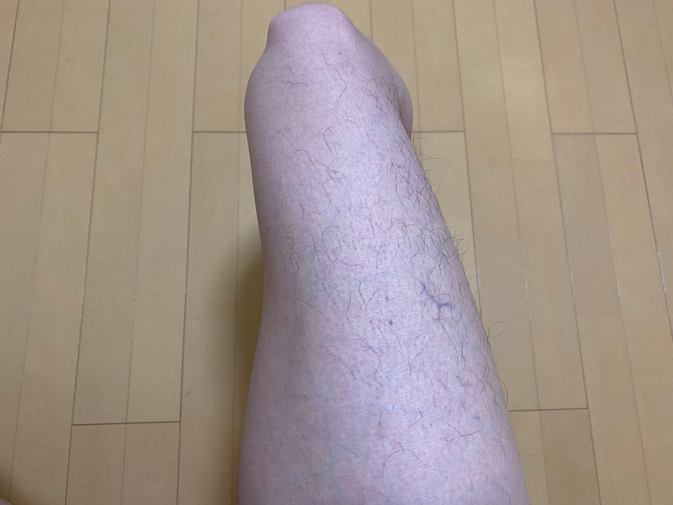 男の全身脱毛効果