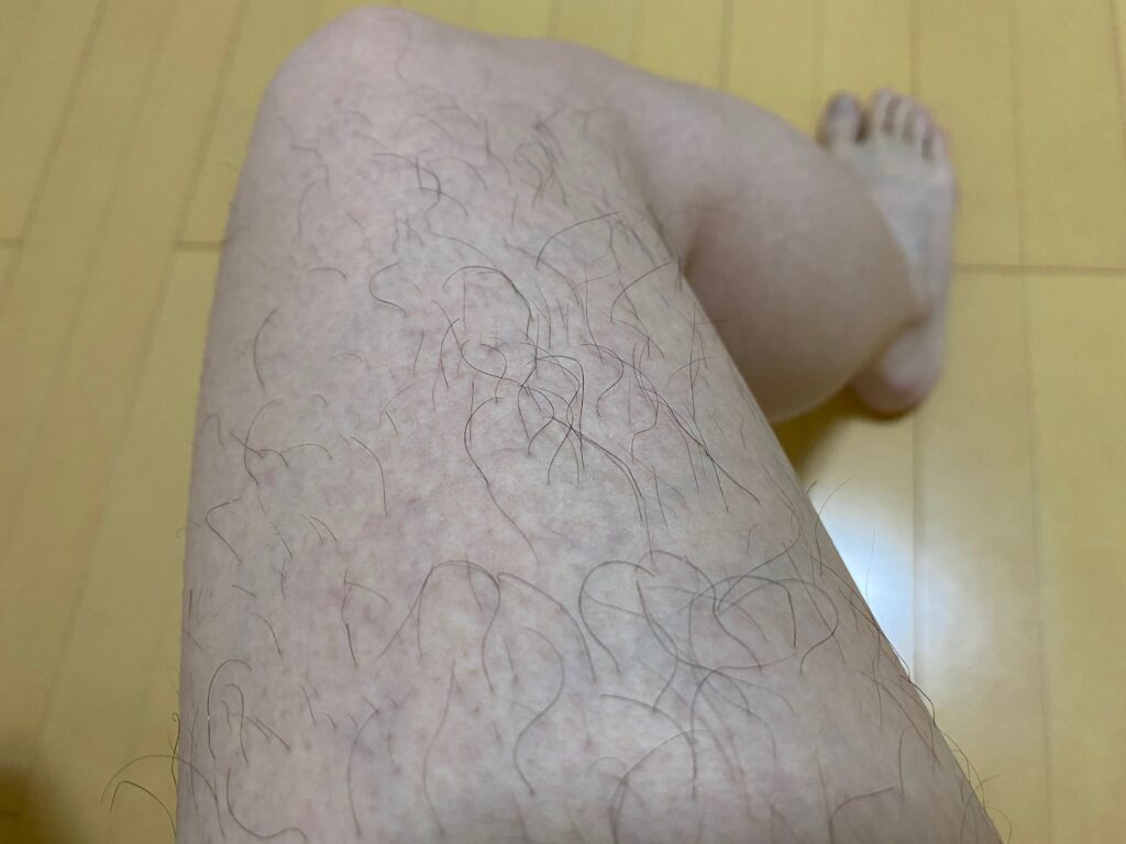 男の全身脱毛効果
