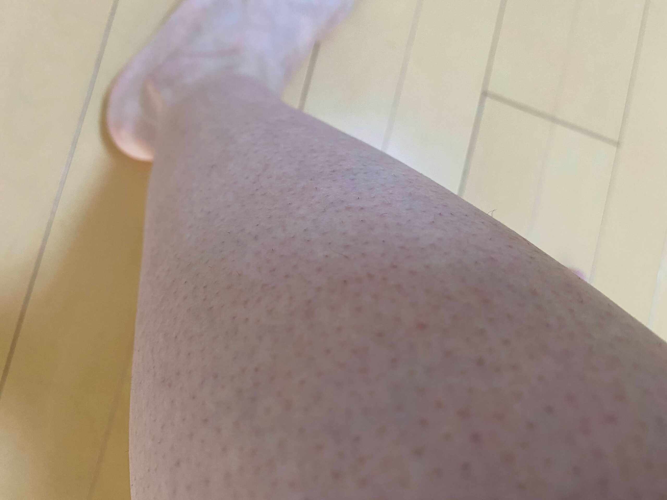 男の全身脱毛効果