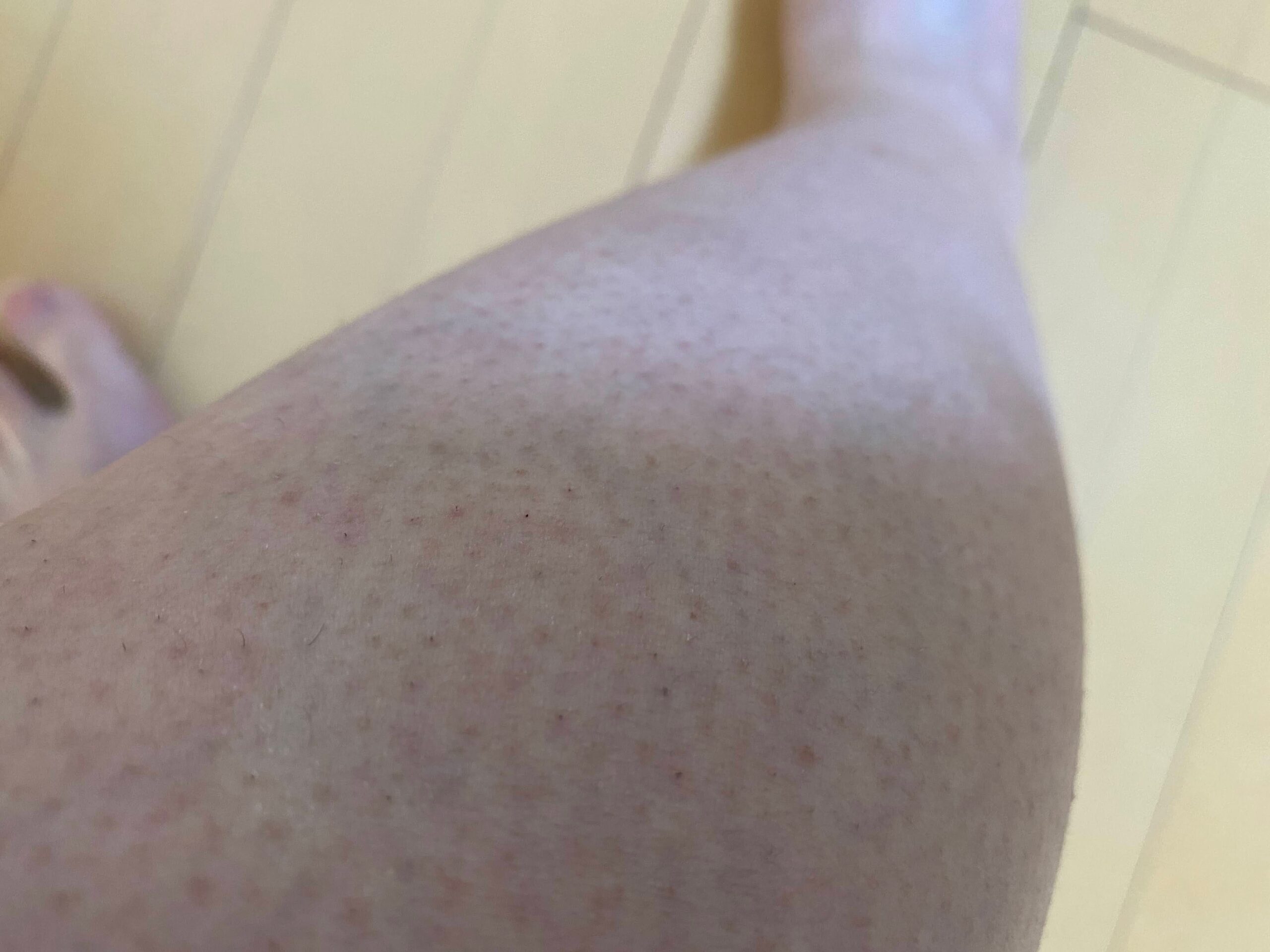 男の全身脱毛効果
