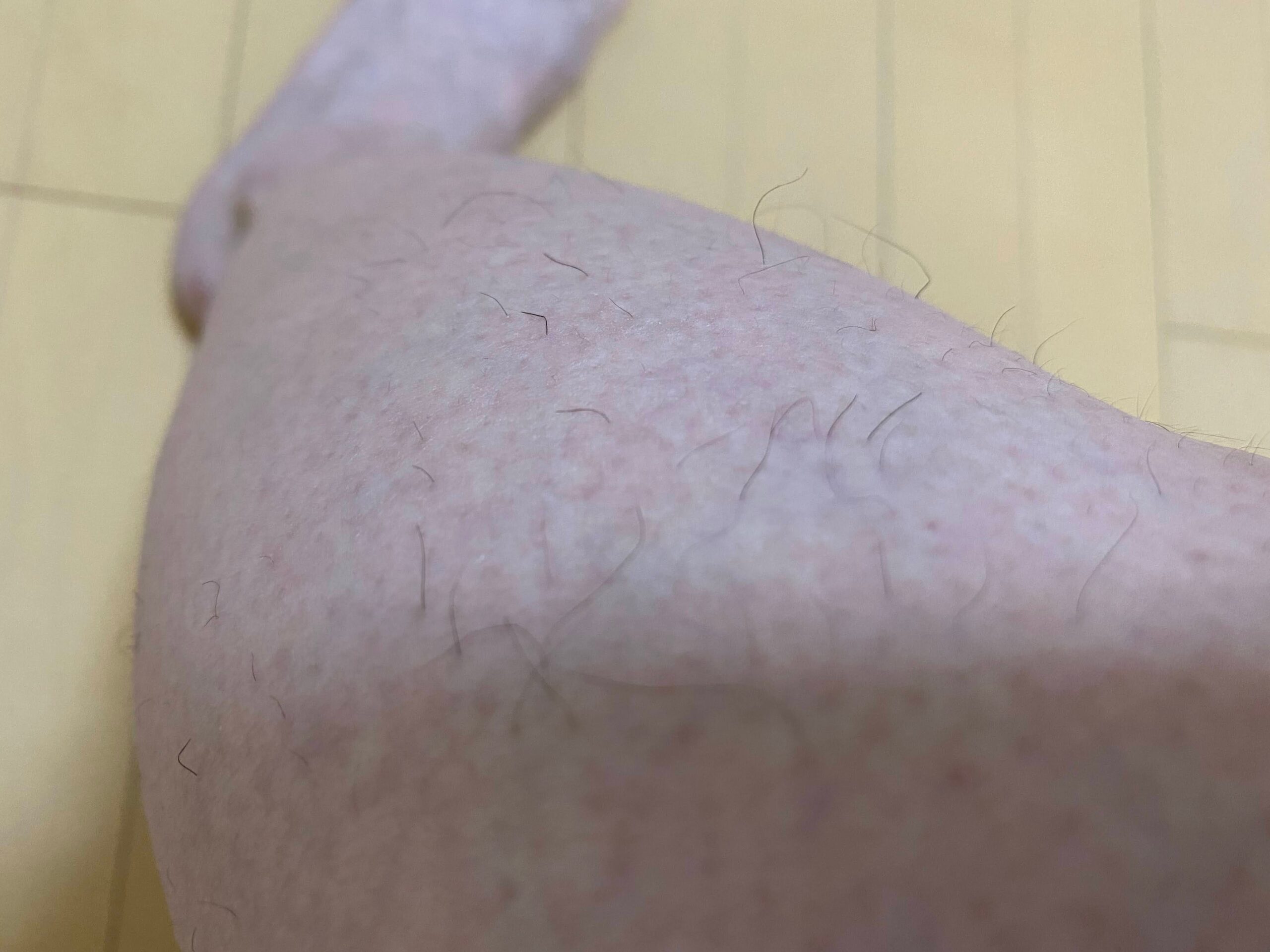 男の全身脱毛効果