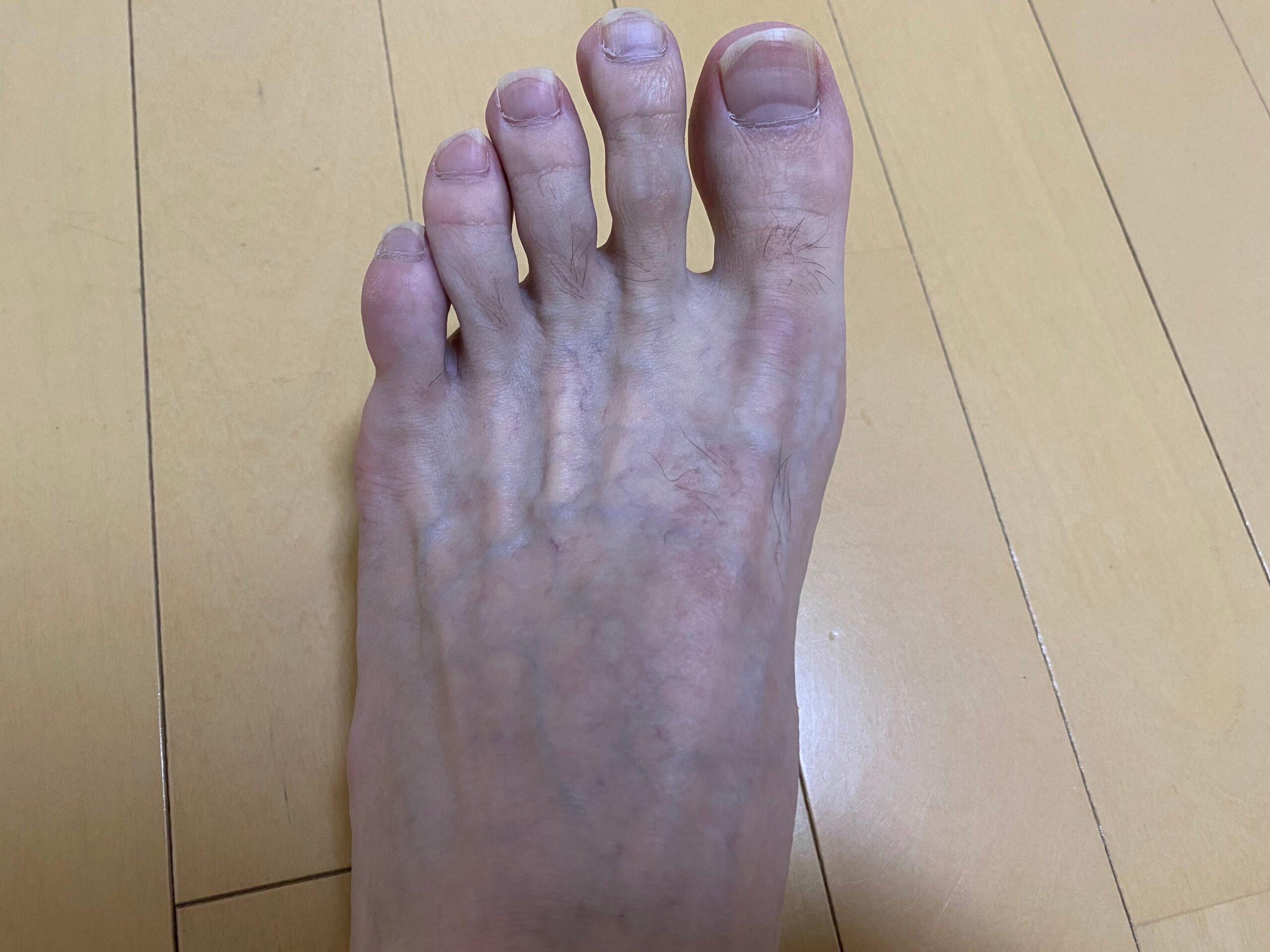 男の全身脱毛効果