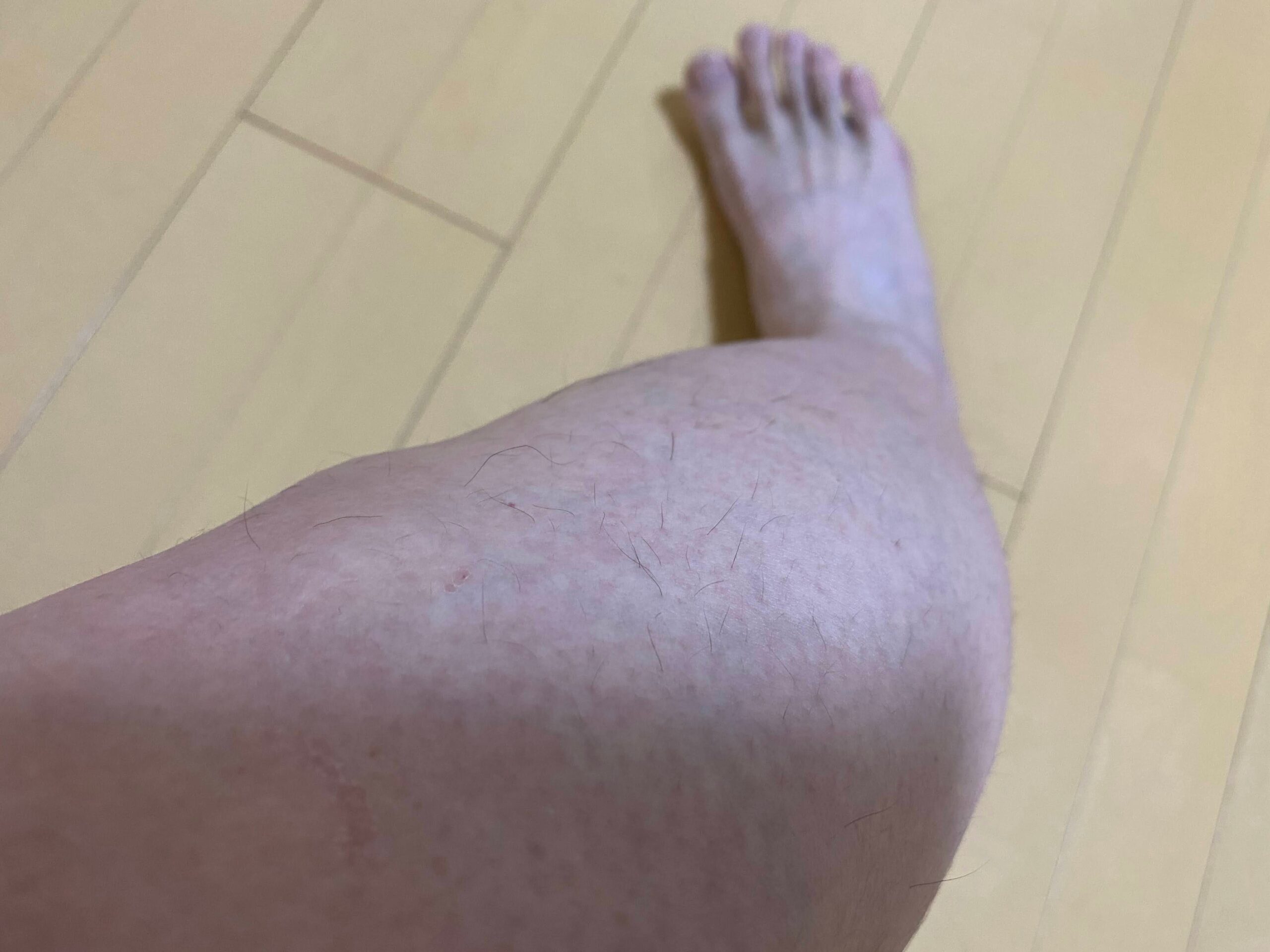 男の全身脱毛効果