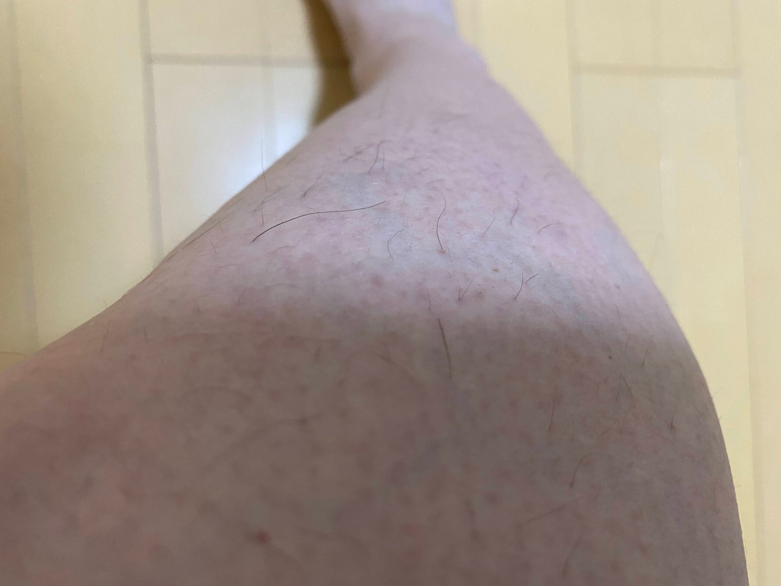 男の全身脱毛効果