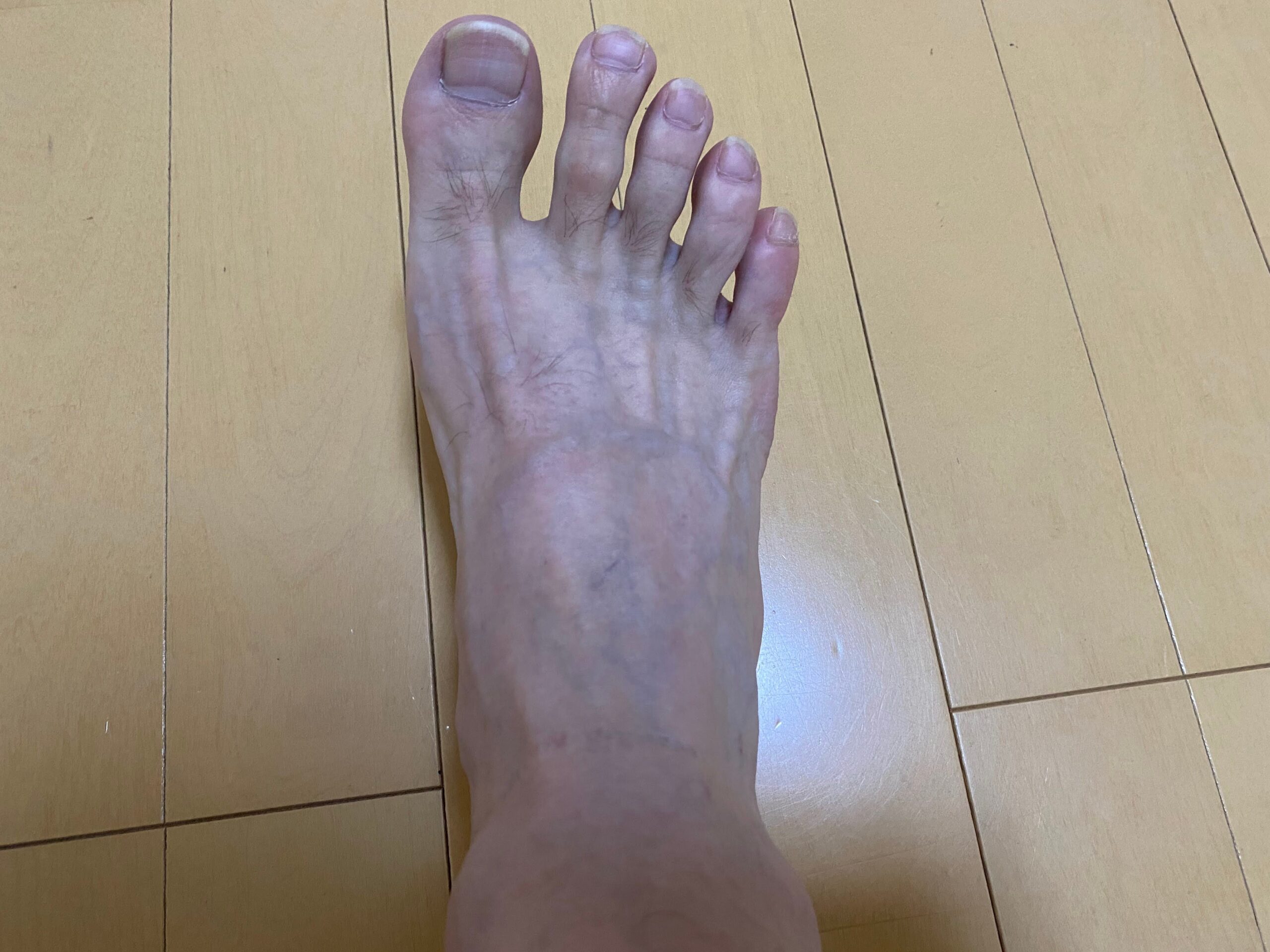 男の全身脱毛効果