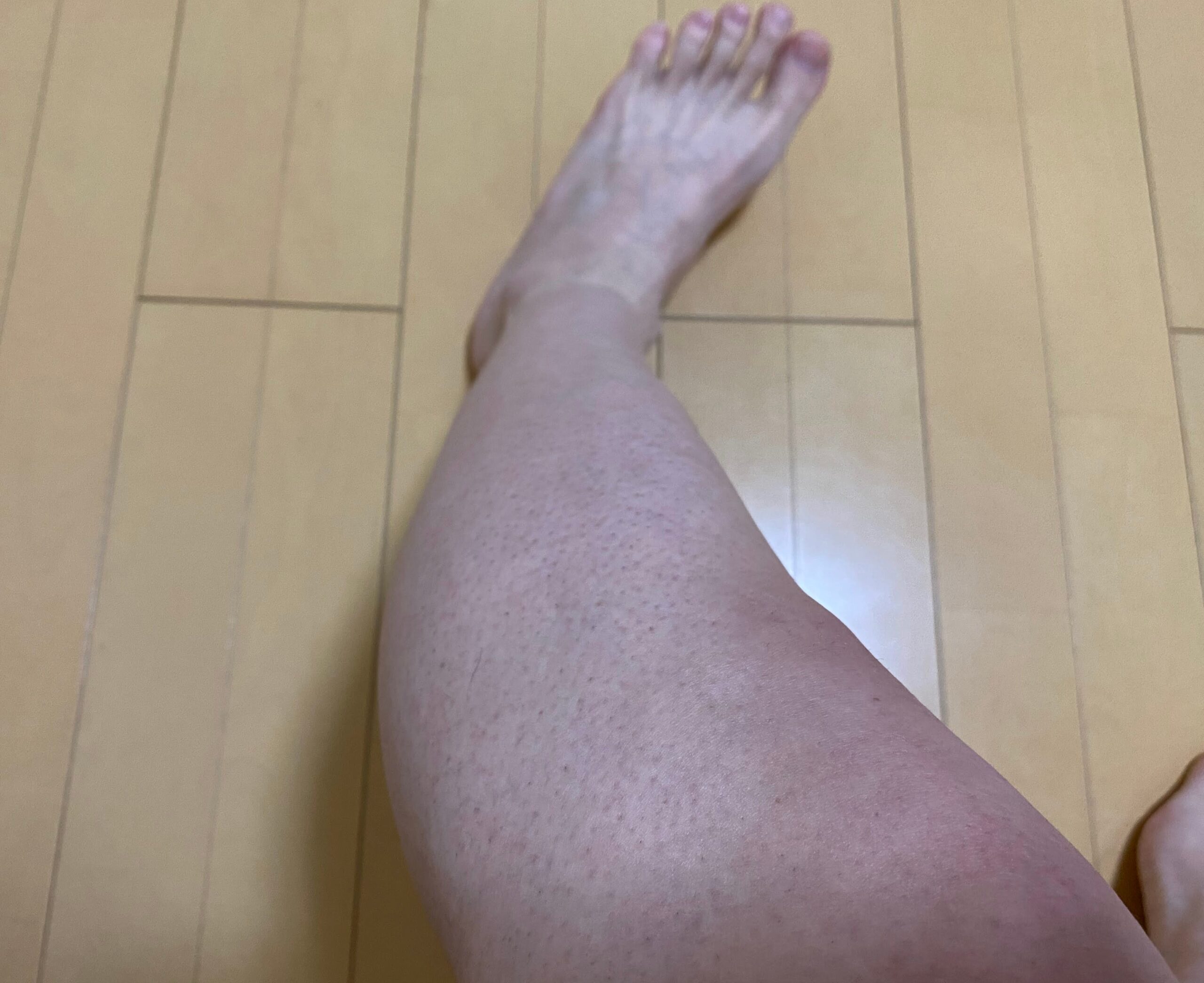 男の全身脱毛効果
