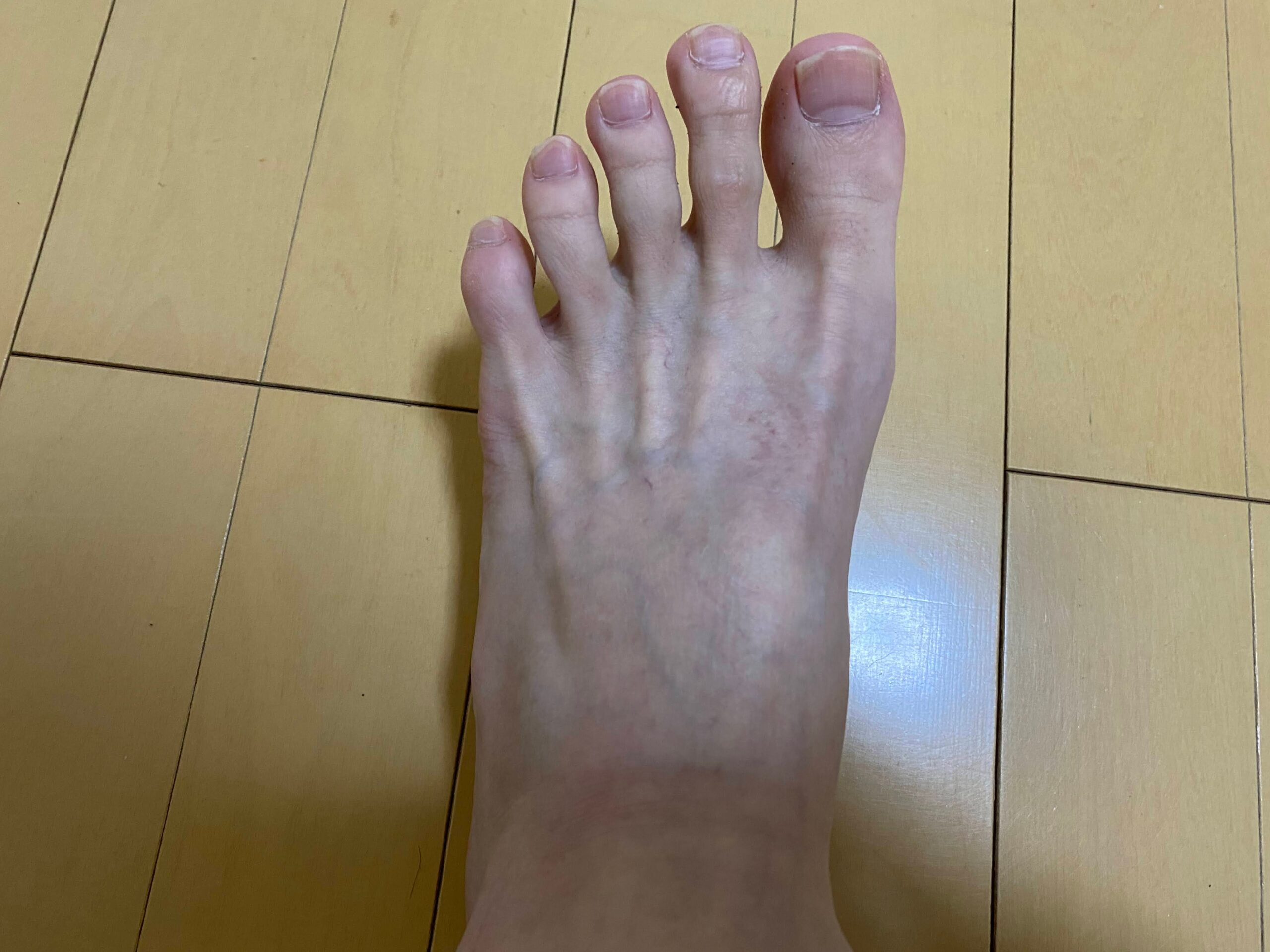 男の全身脱毛効果