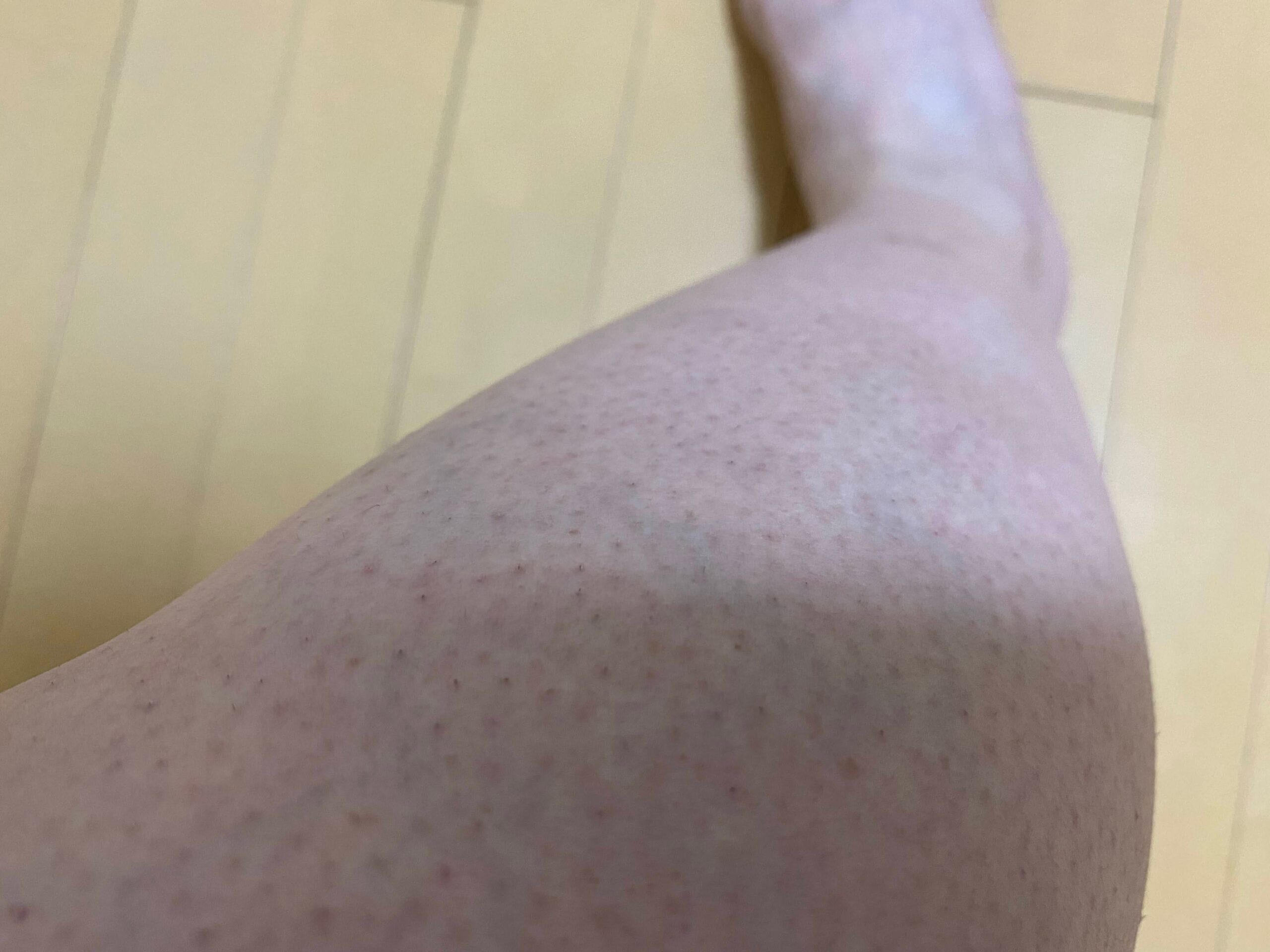 男の全身脱毛効果