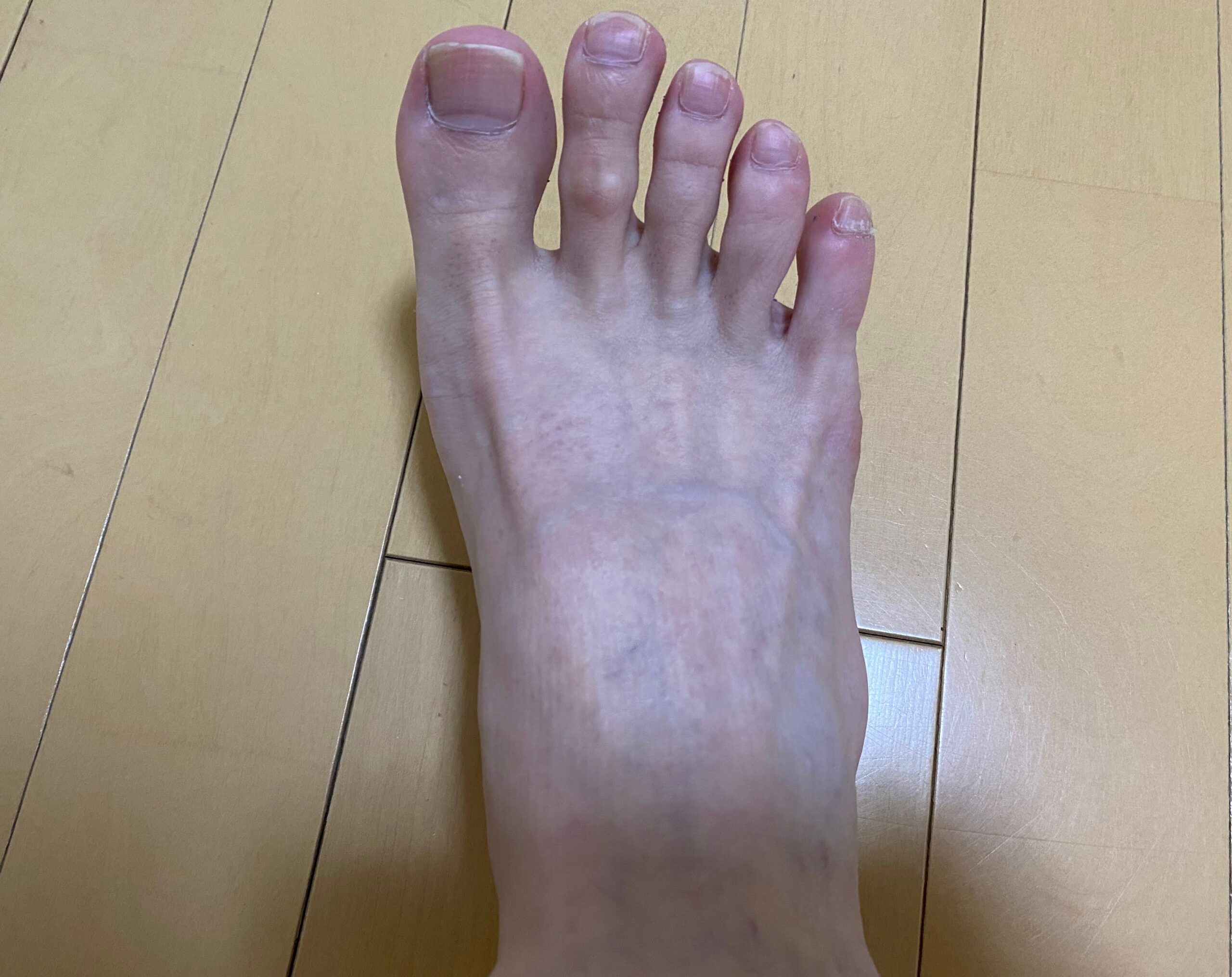 男の全身脱毛効果