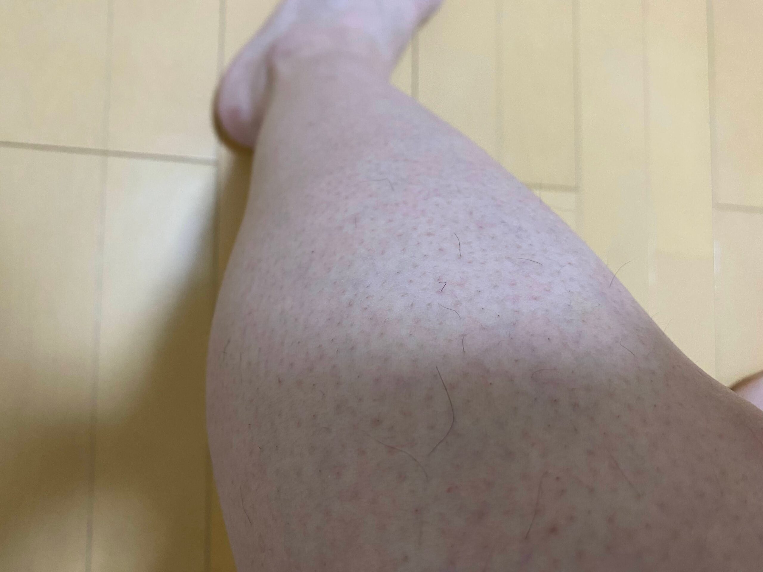 男の全身脱毛効果