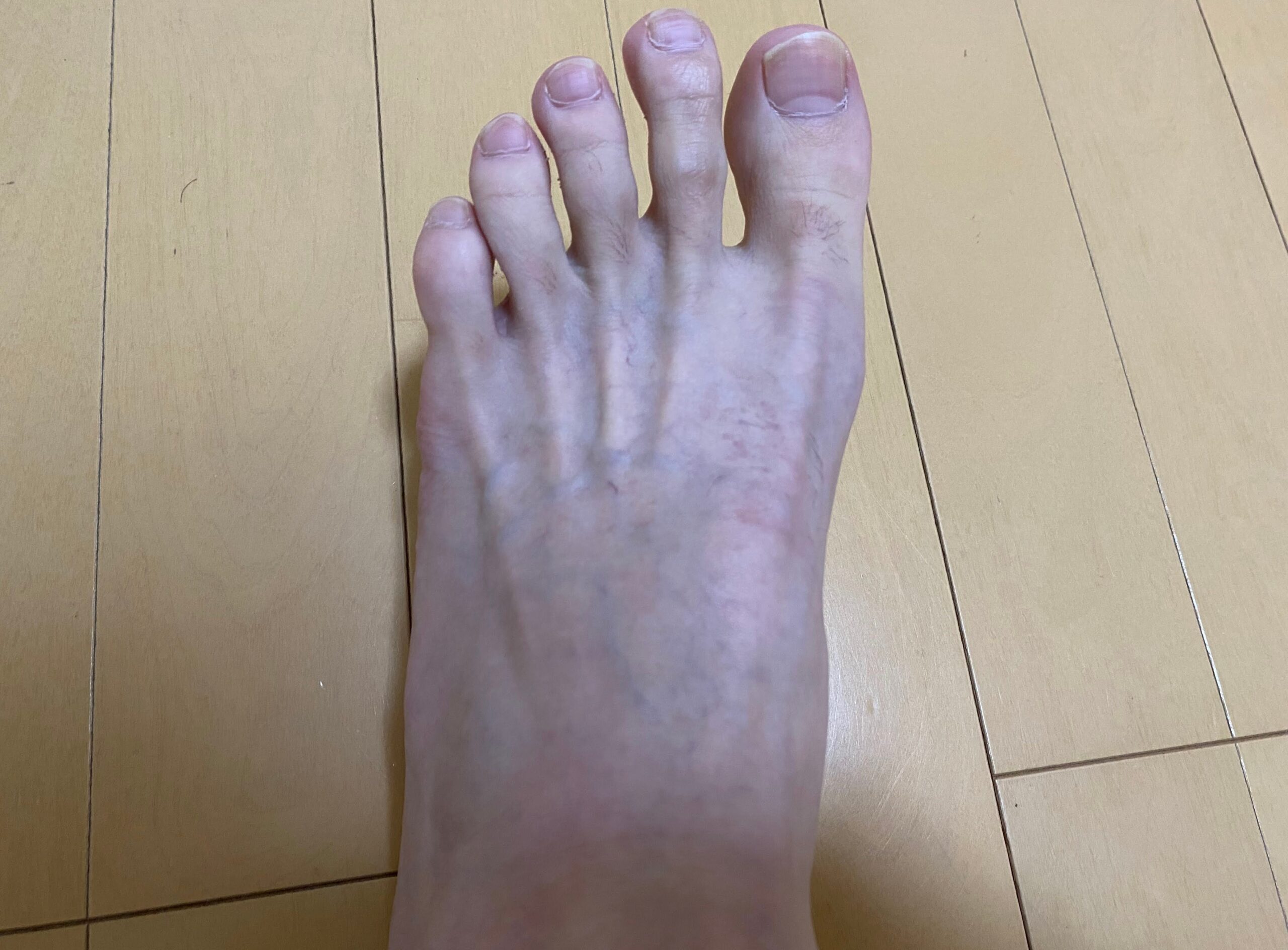 男の全身脱毛効果