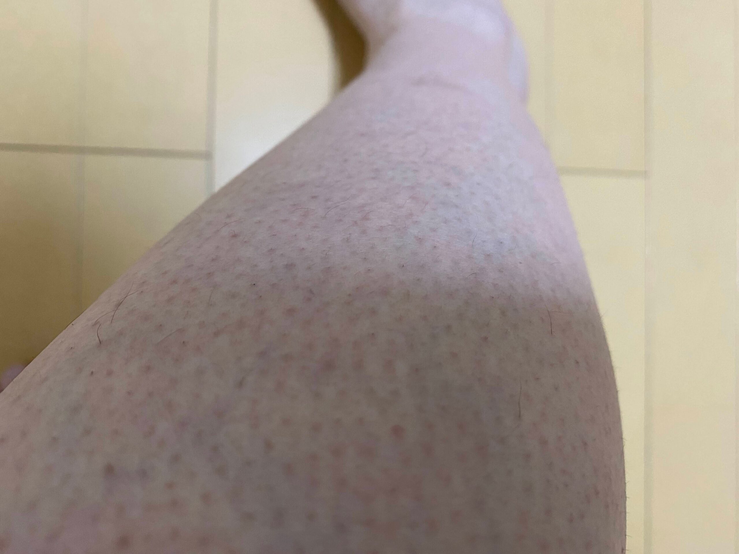 男の全身脱毛効果