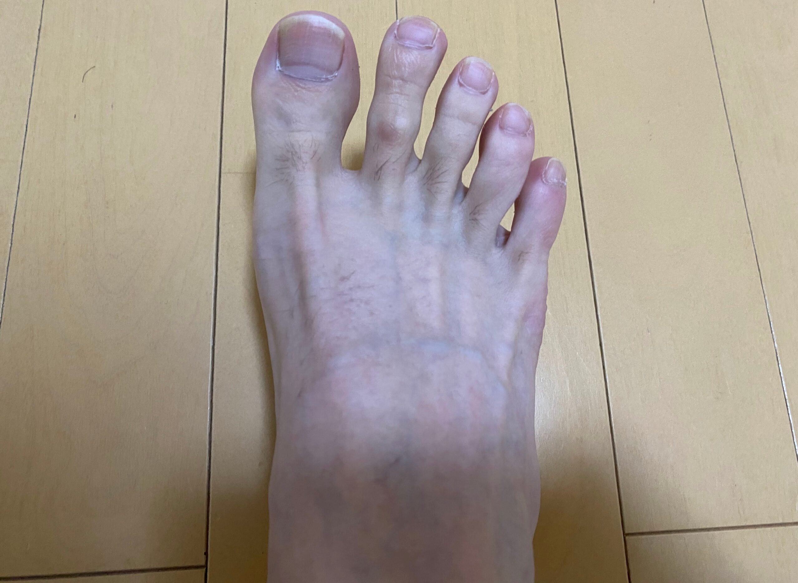男の全身脱毛効果
