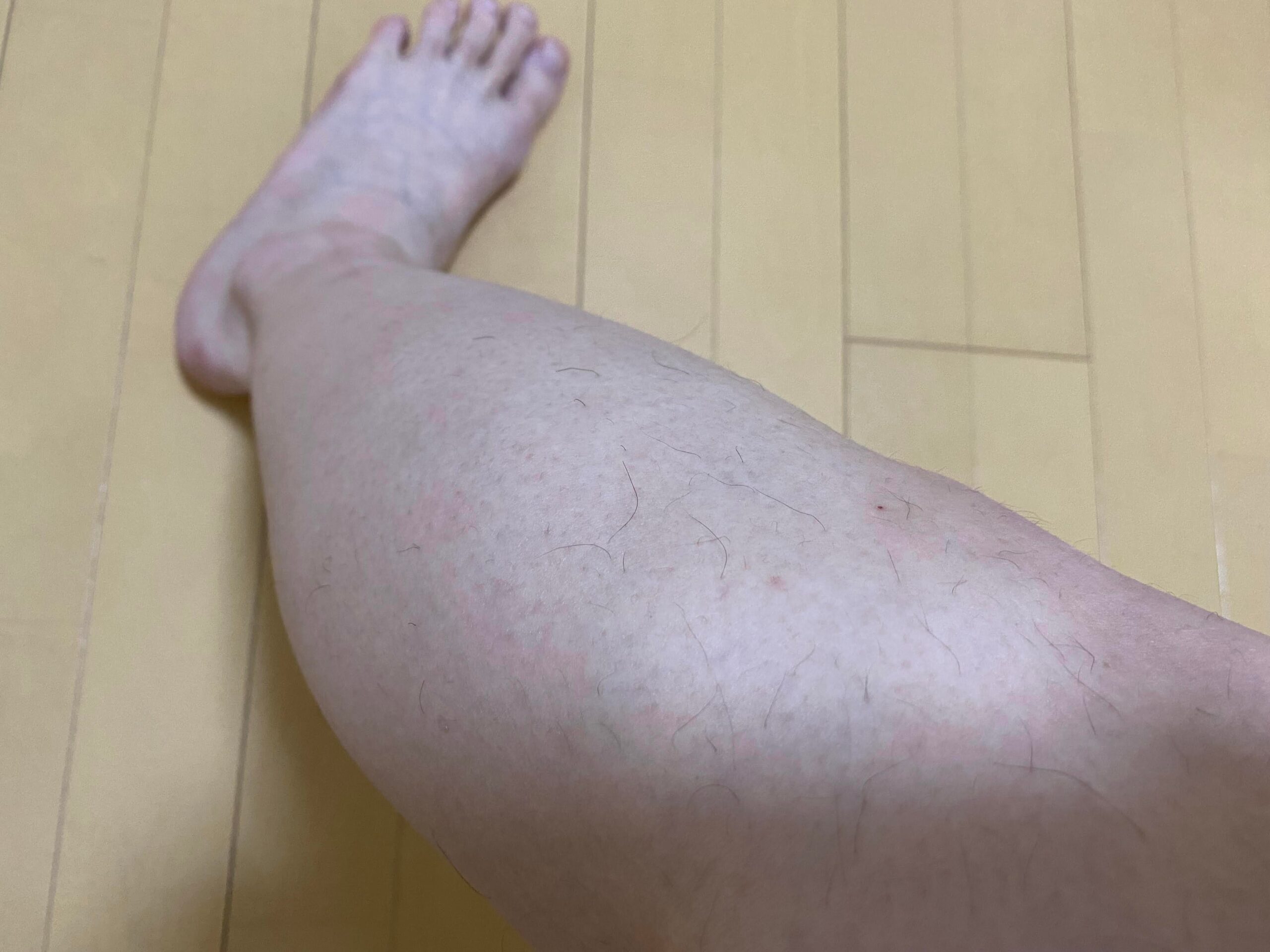 男の全身脱毛効果