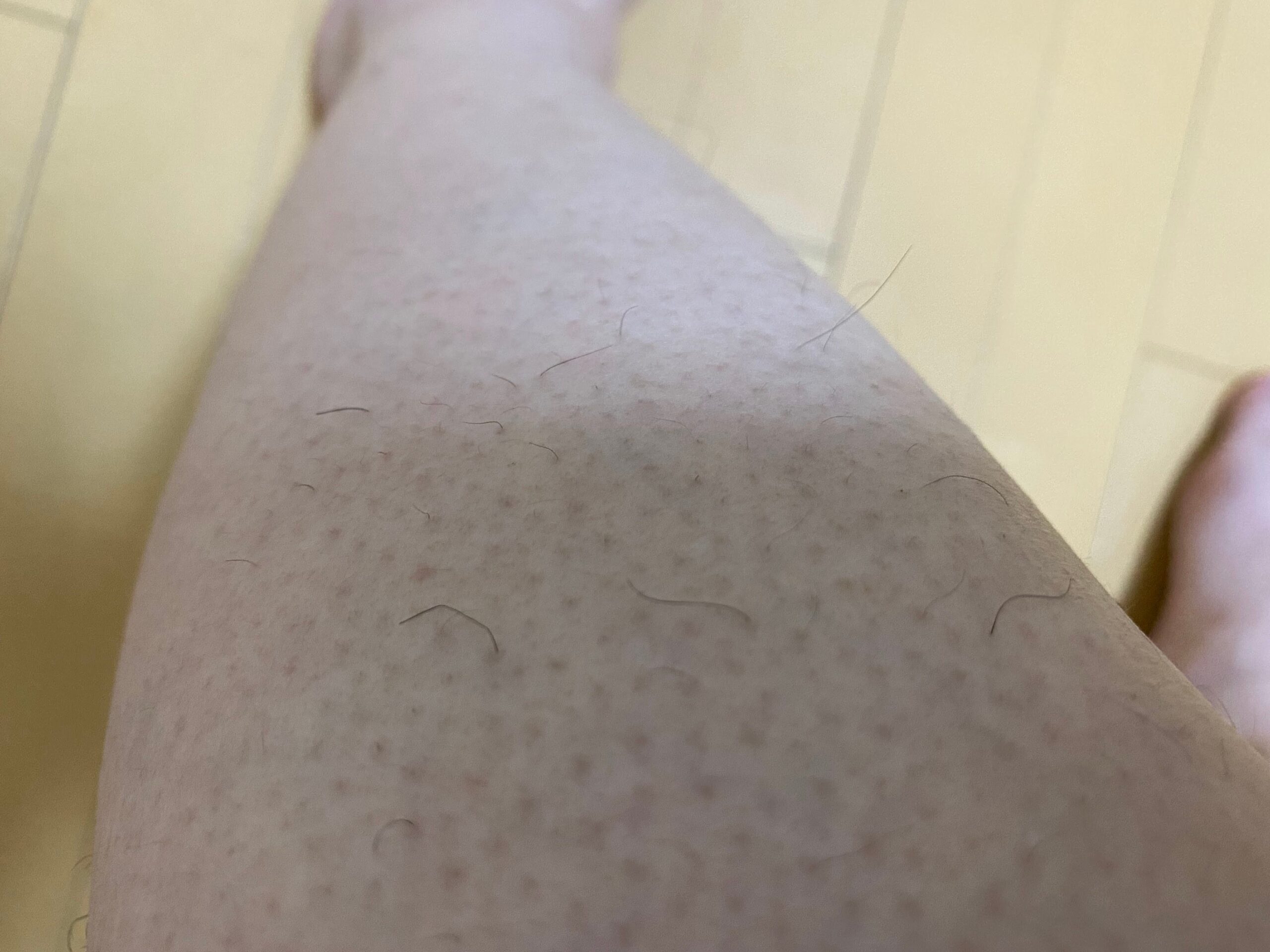 男の全身脱毛効果