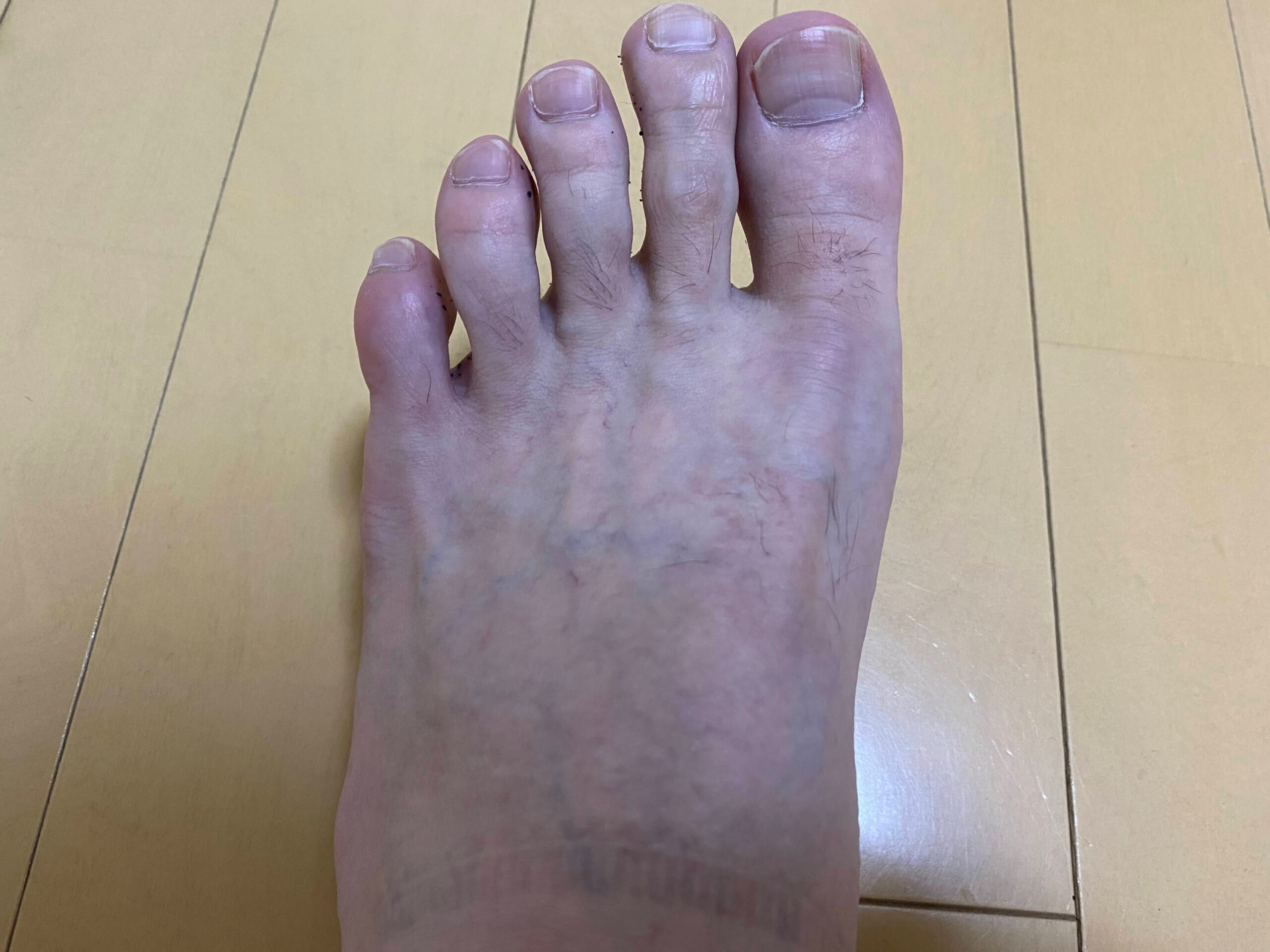 男の全身脱毛効果
