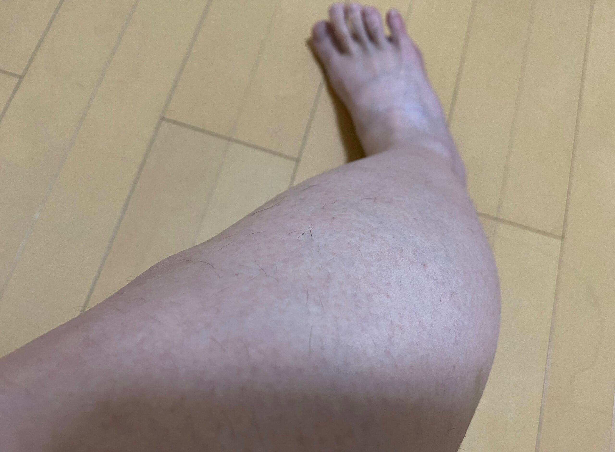 男の全身脱毛効果