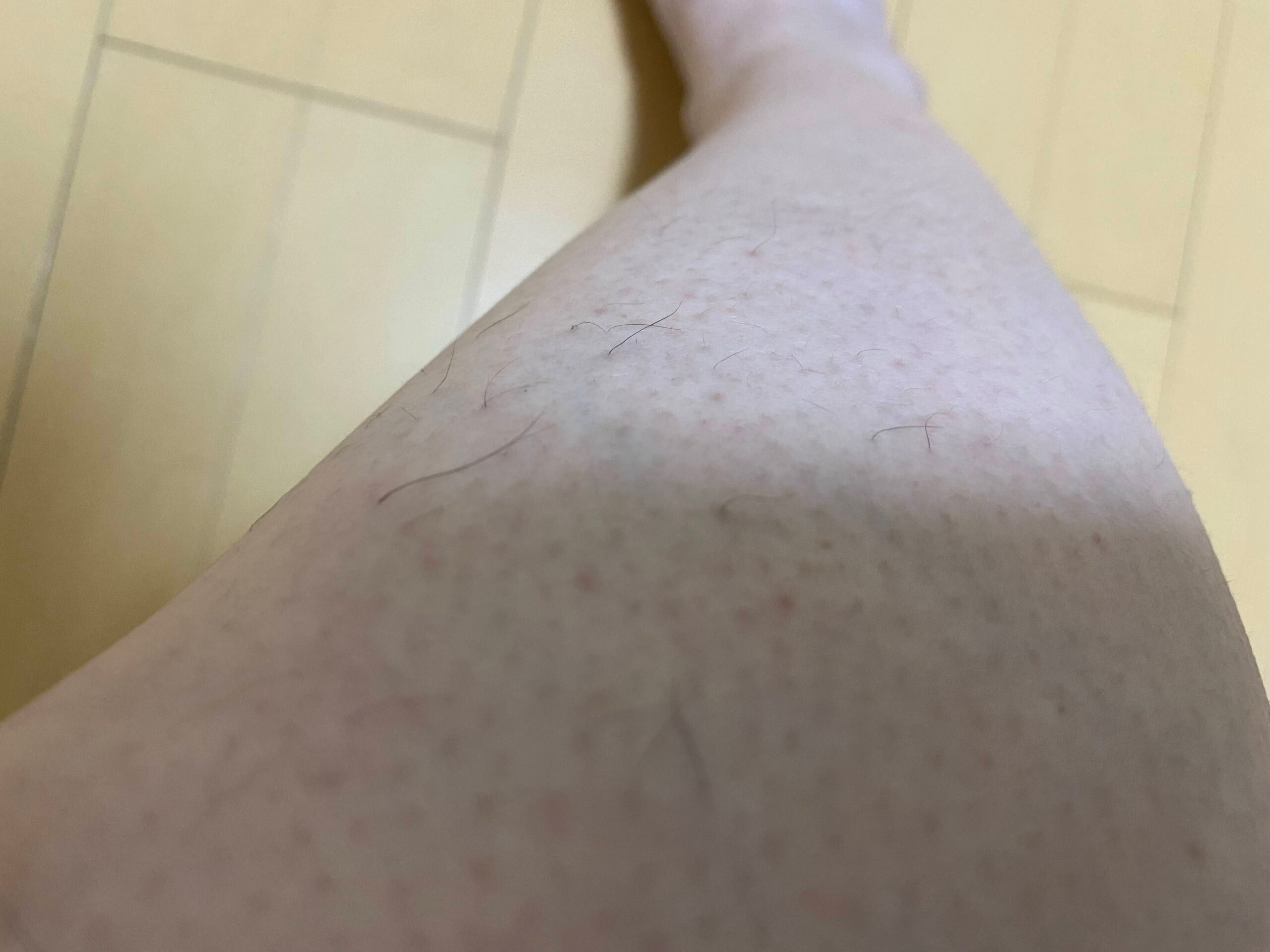 男の全身脱毛効果