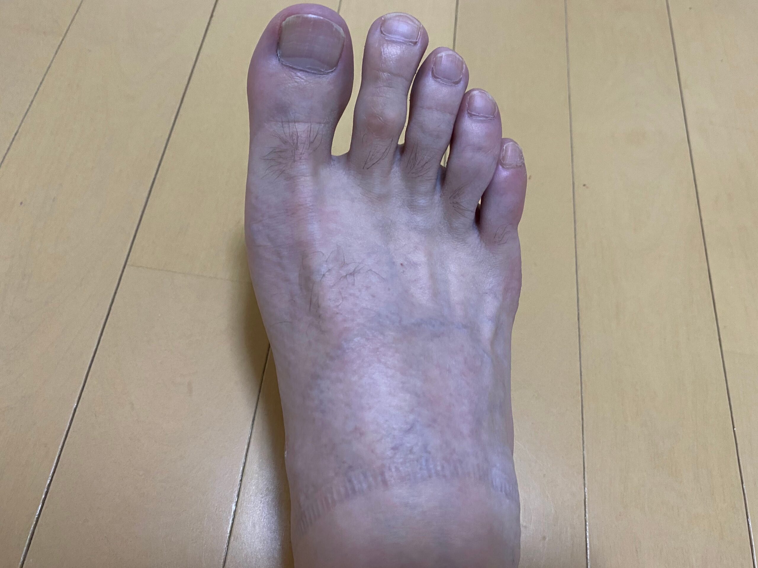 男の全身脱毛効果