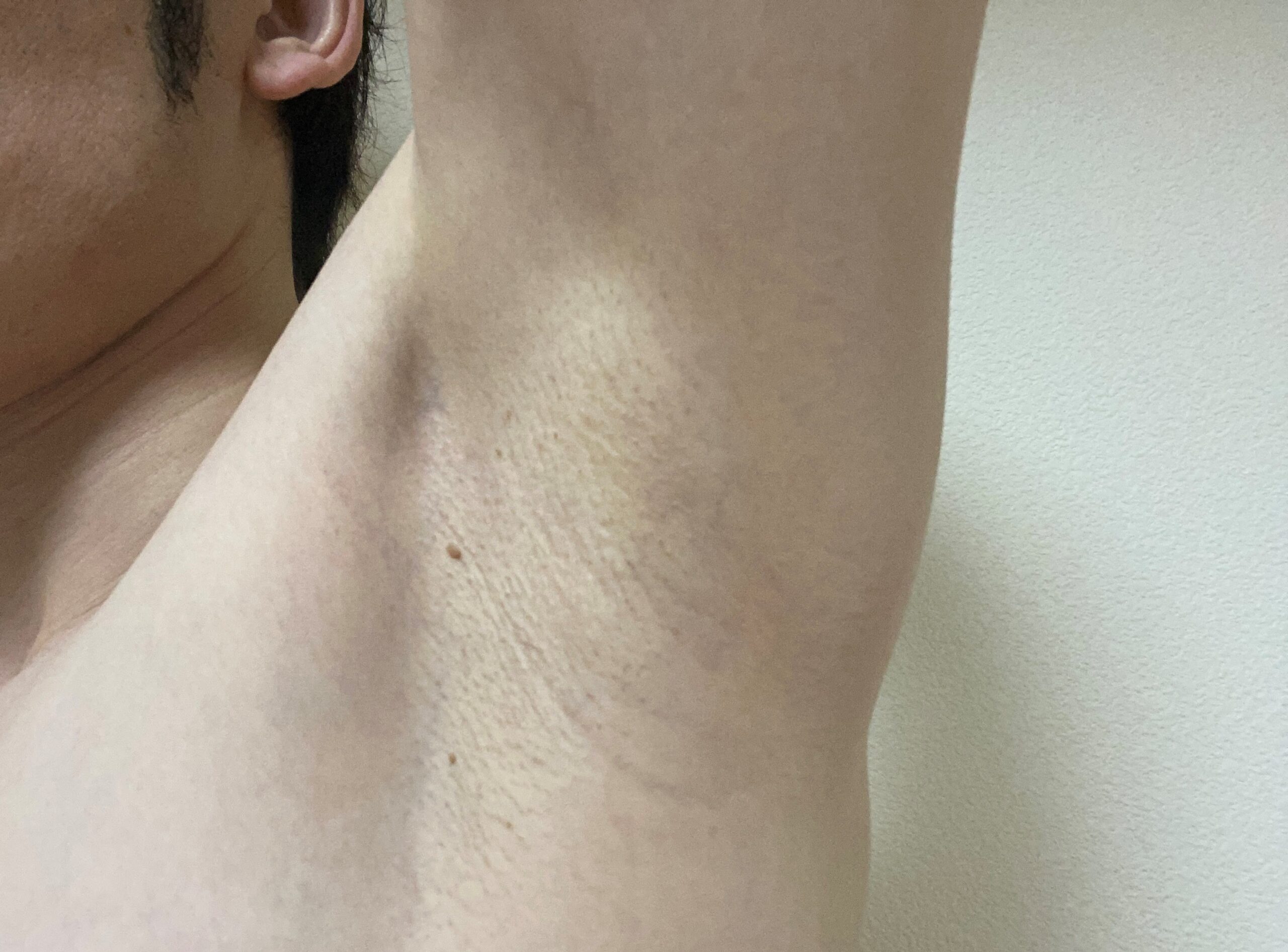 男の全身脱毛の効果