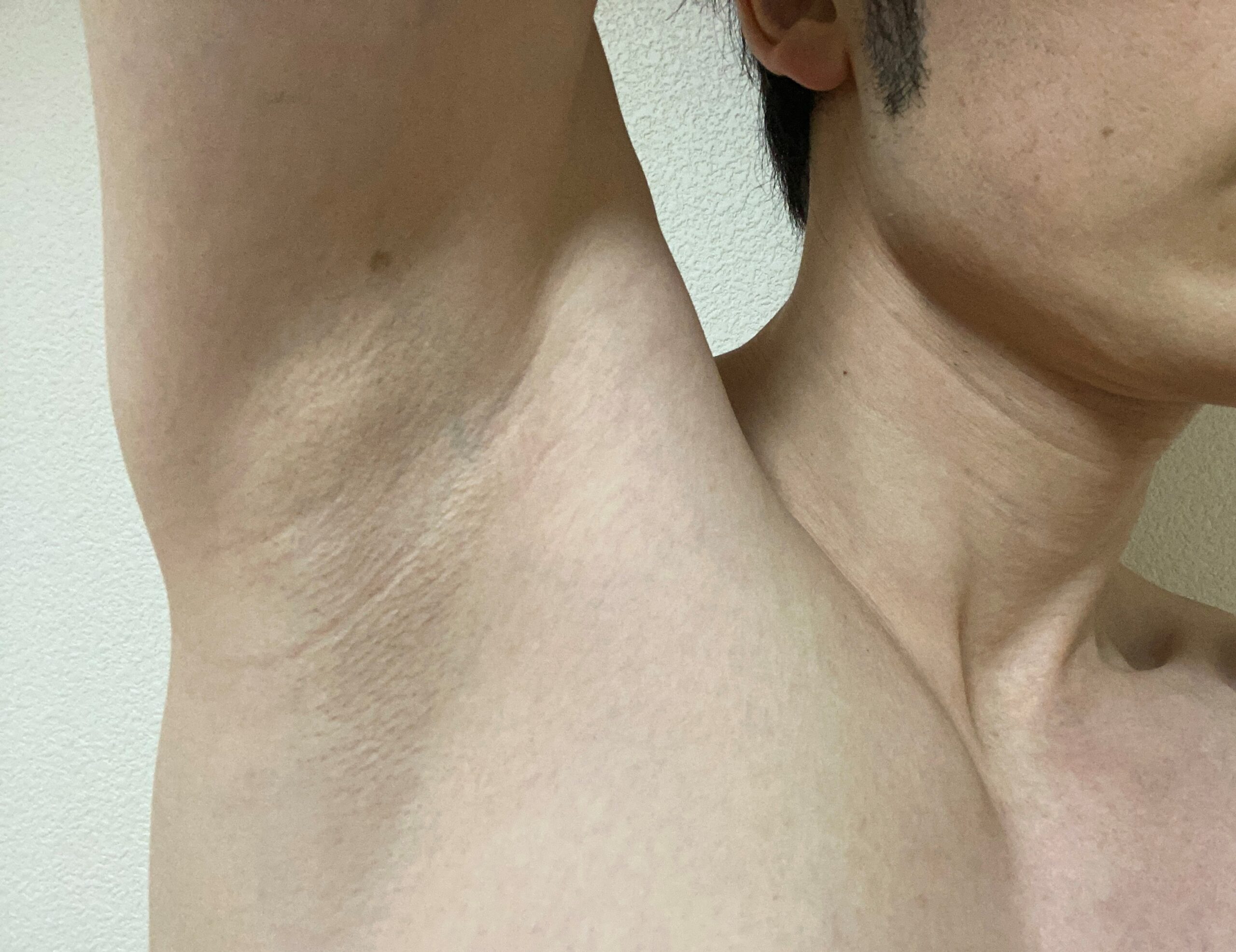 男の全身脱毛の効果