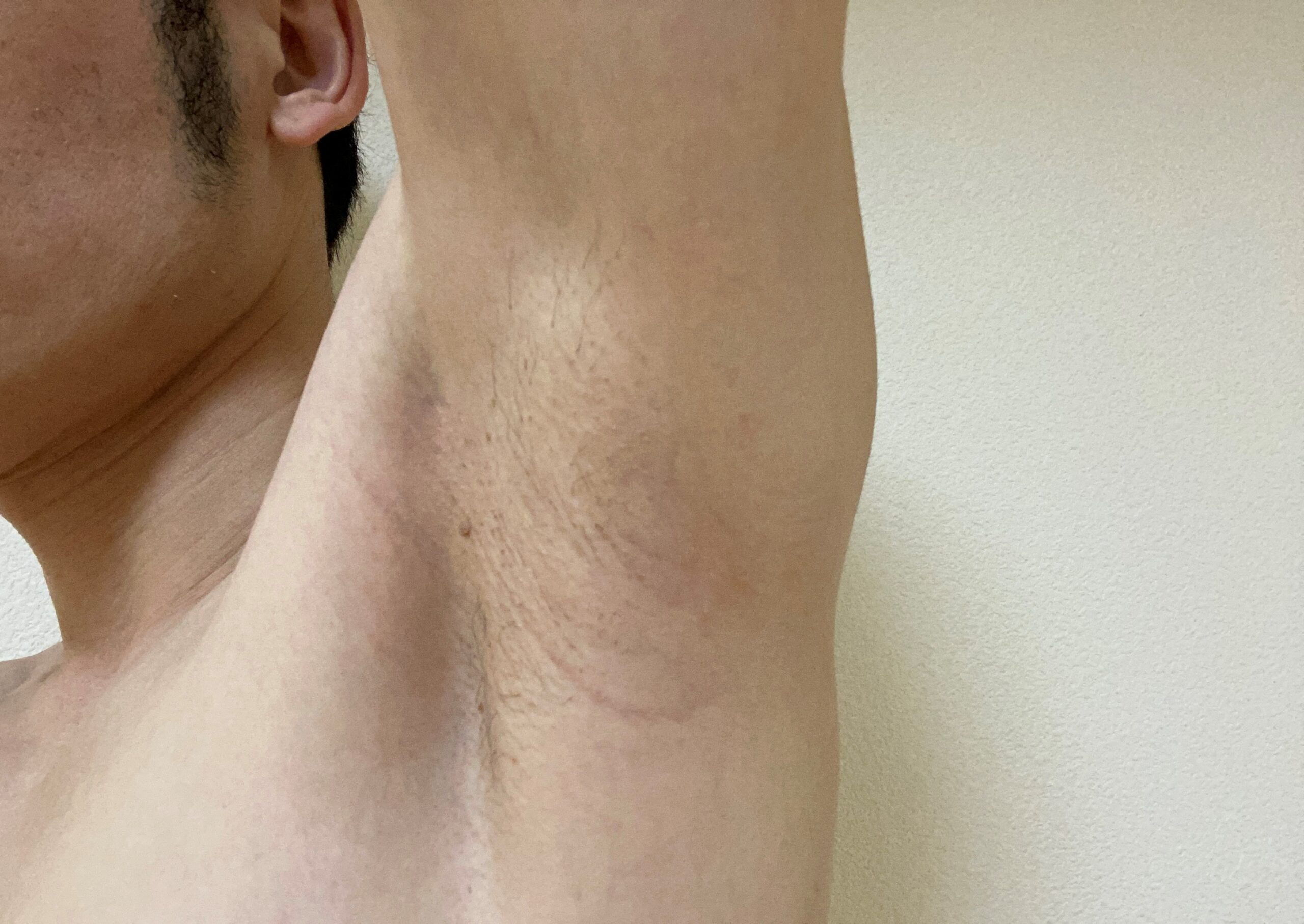 男の全身脱毛効果