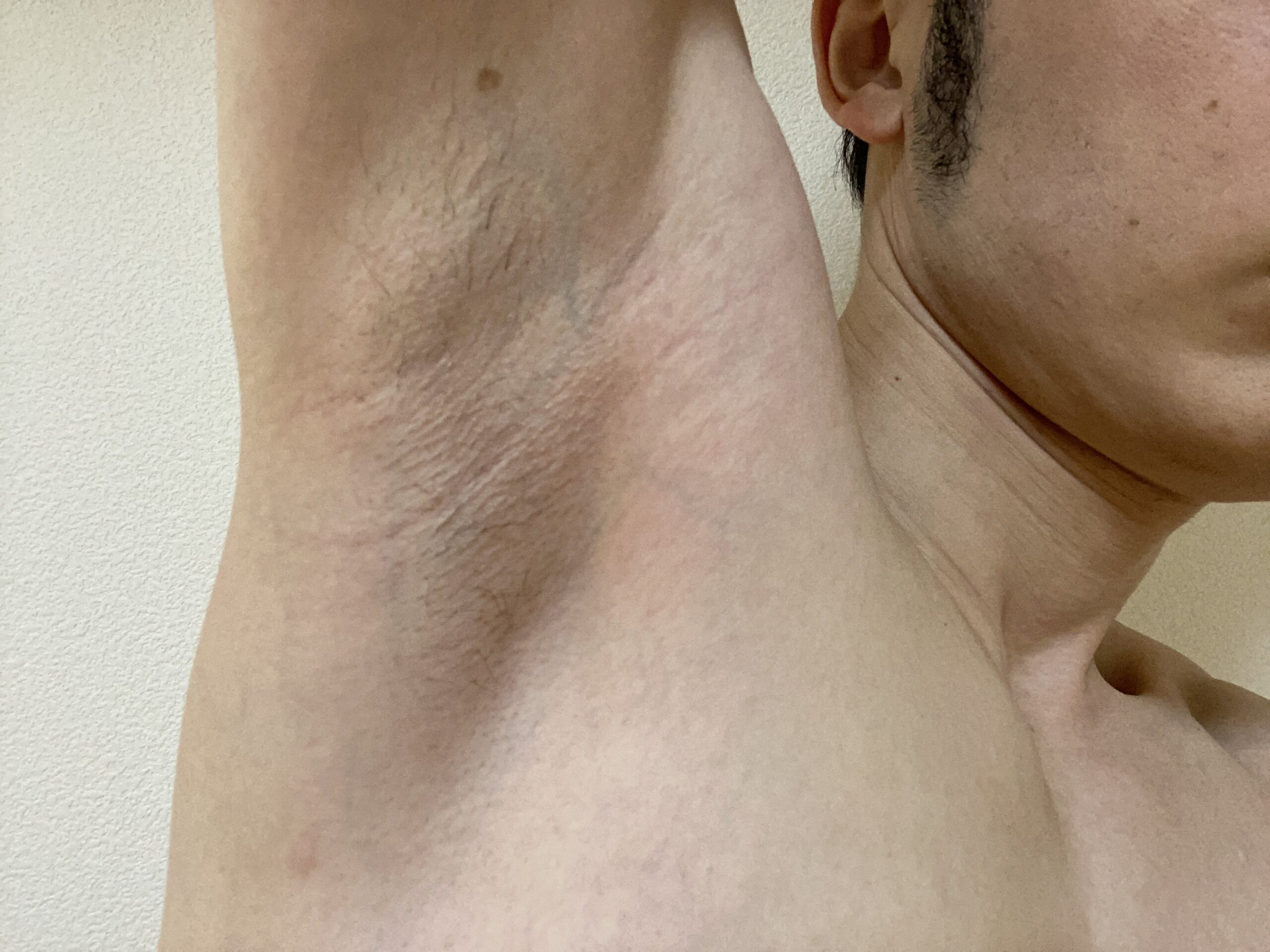 男の全身脱毛効果