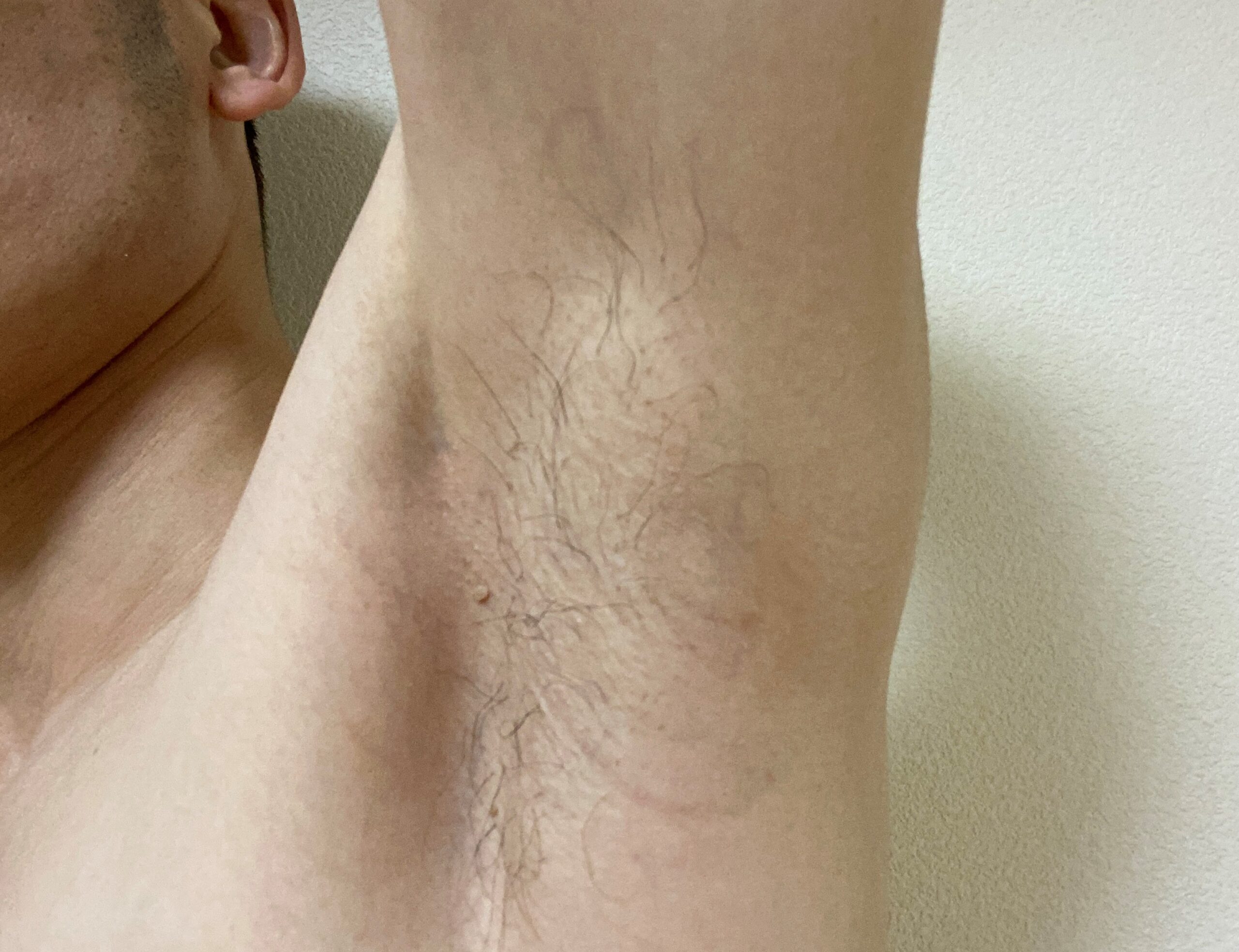 男の全身脱毛効果