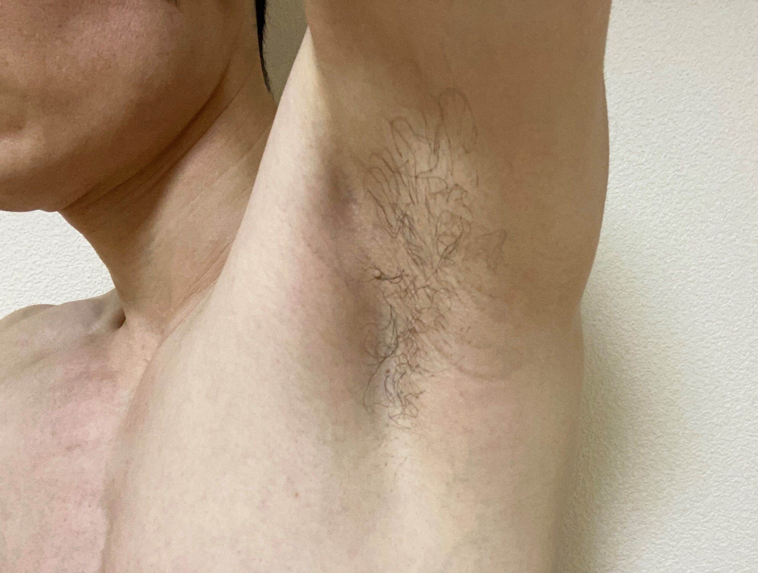 男の全身脱毛効果