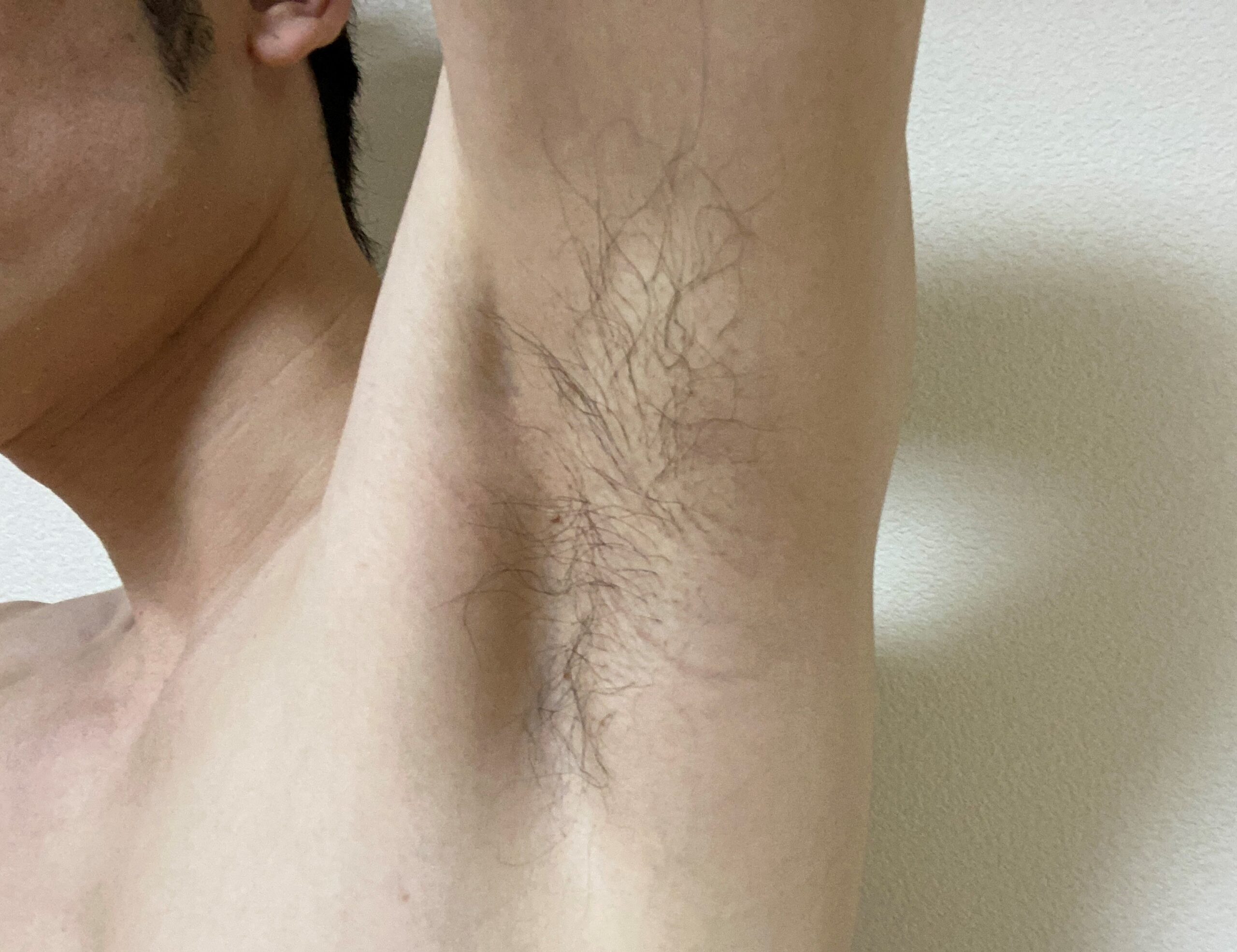 男の全身脱毛効果
