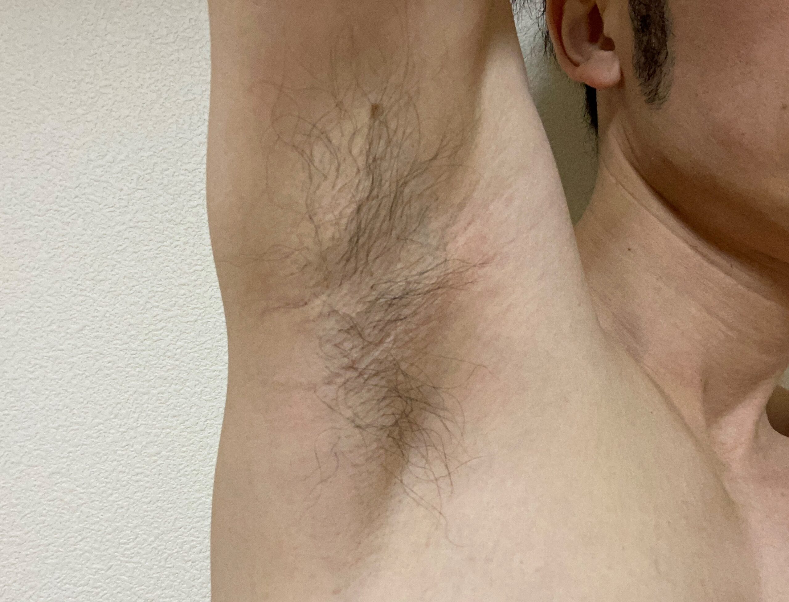 男の全身脱毛効果