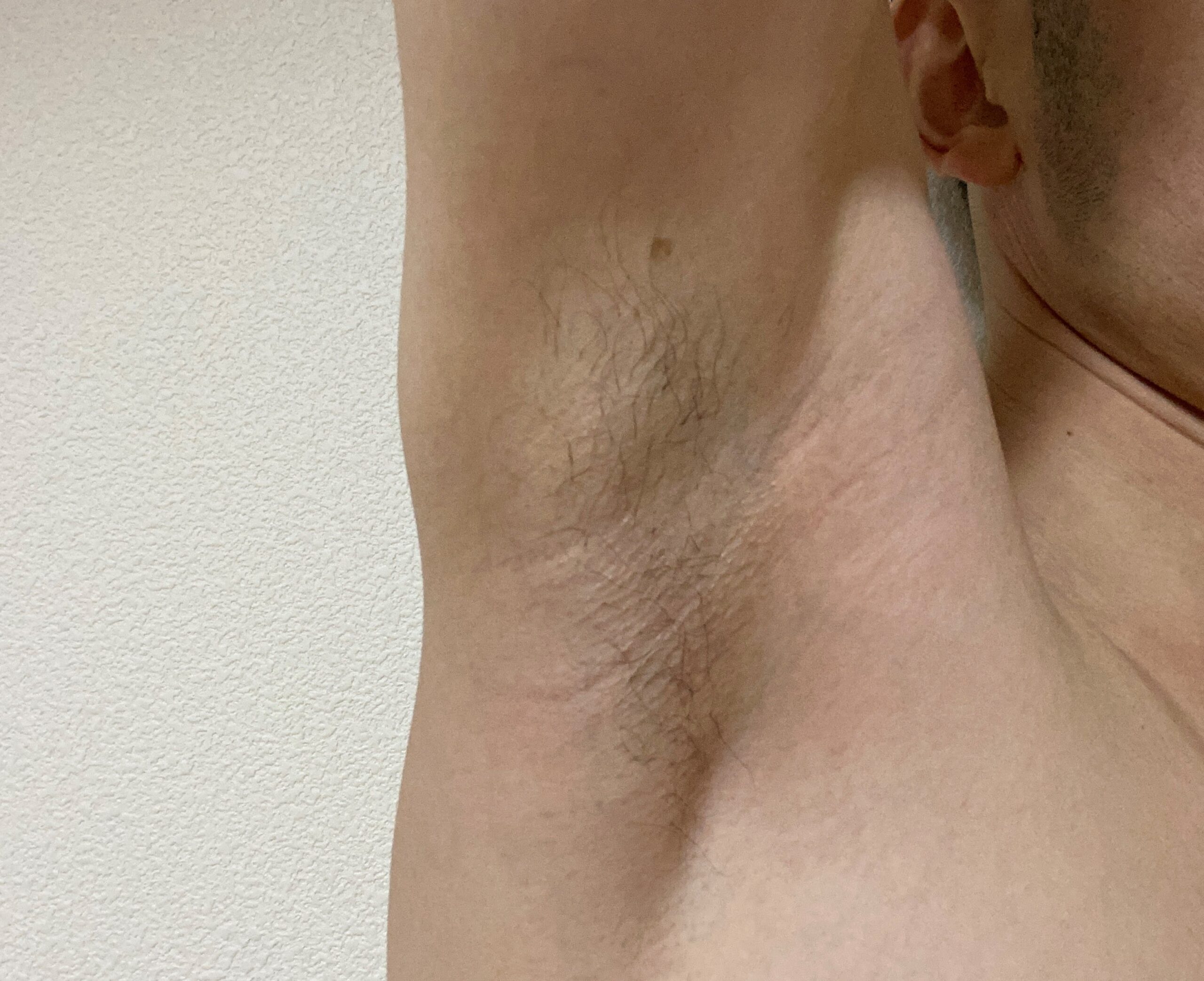 男の全身脱毛効果