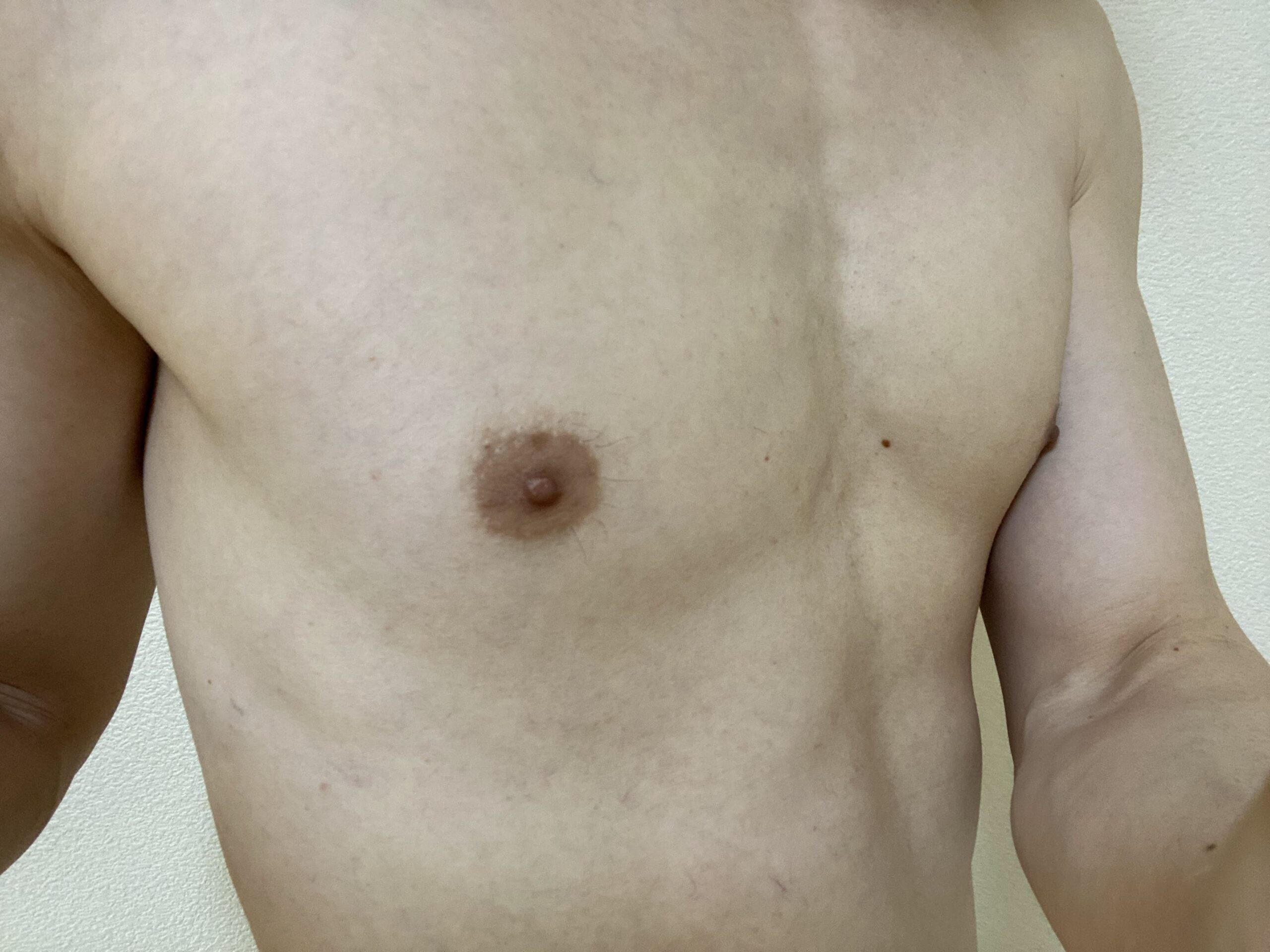 男の全身脱毛効果