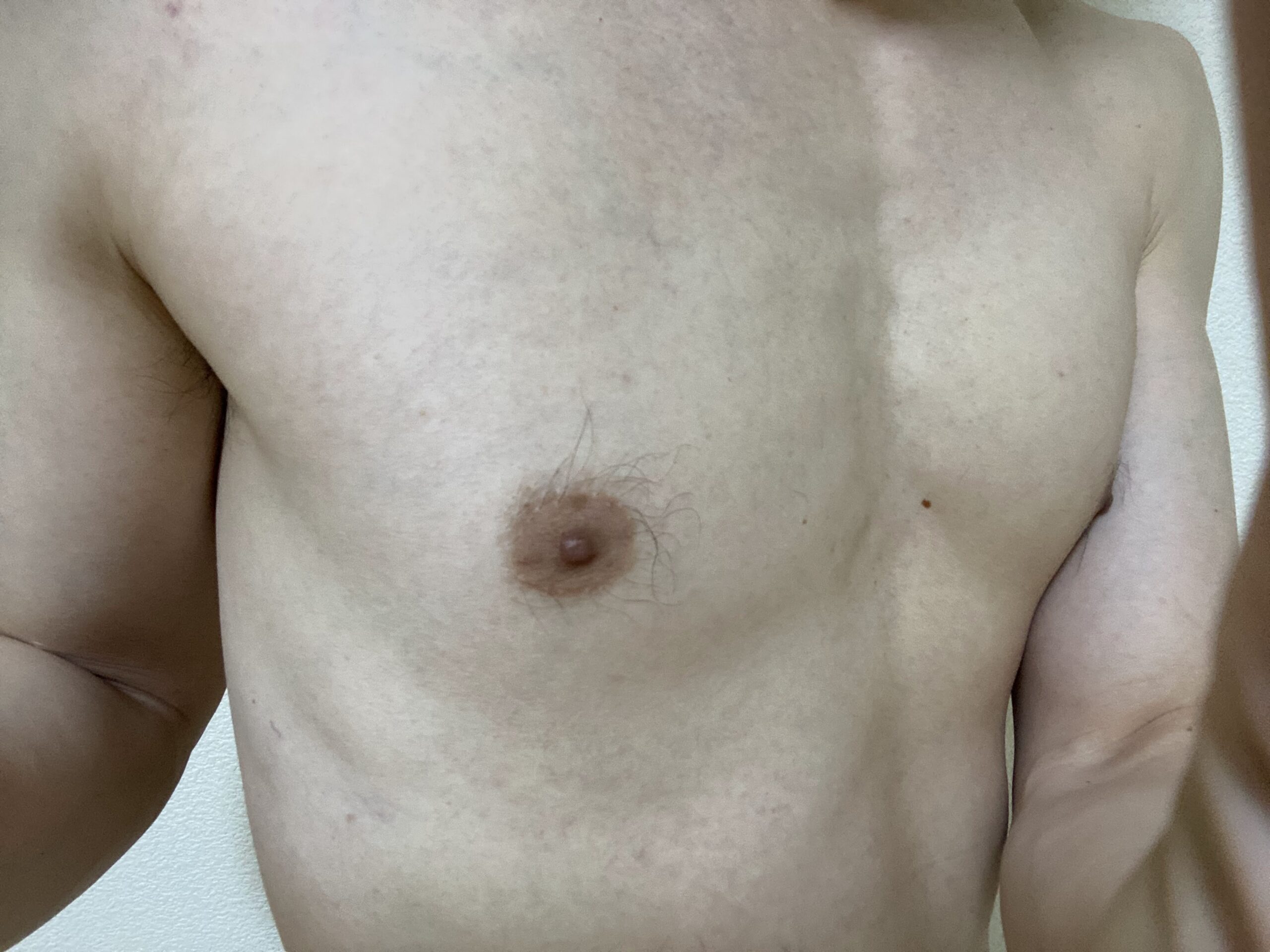 男の全身脱毛効果