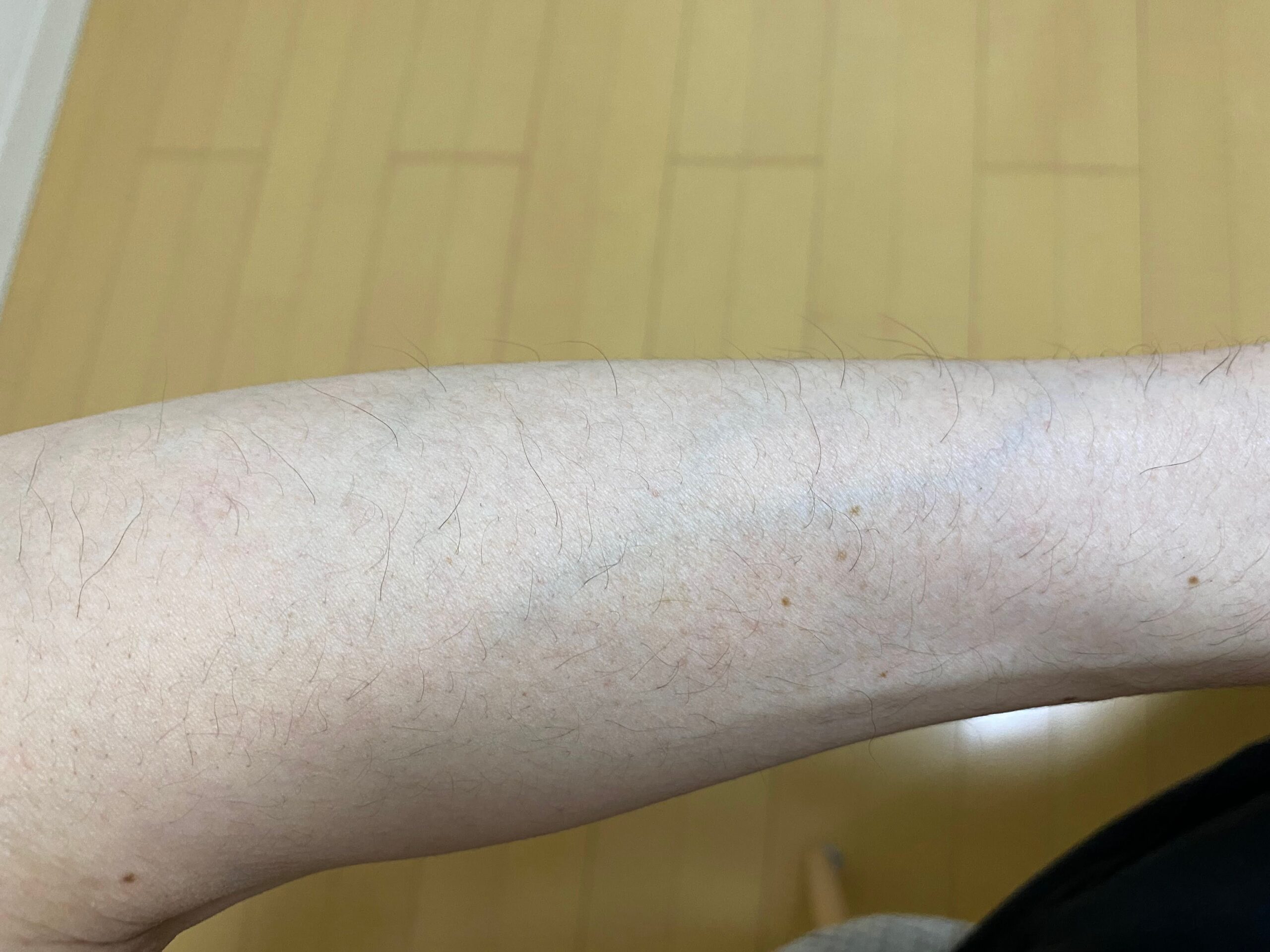男の全身脱毛の効果