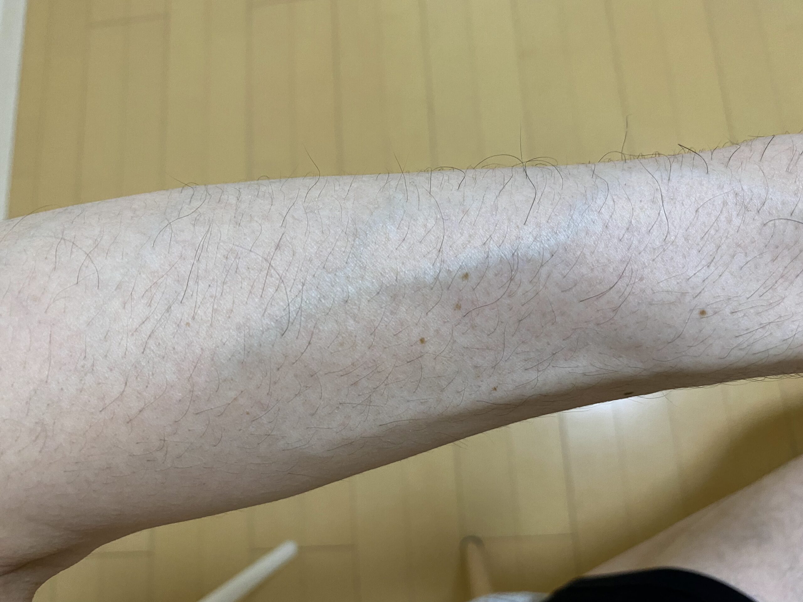 男の全身脱毛の効果