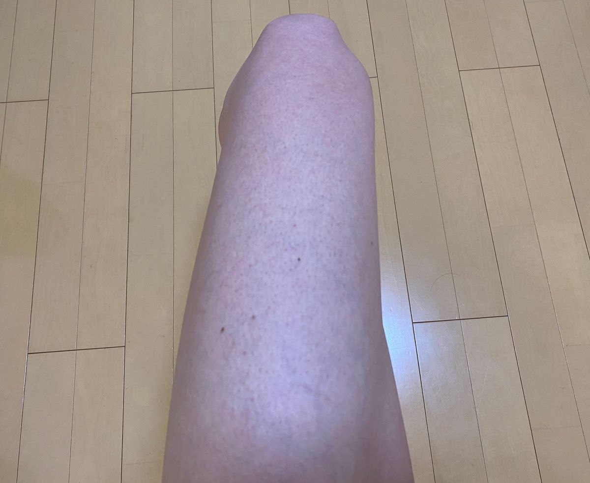 男の全身脱毛効果