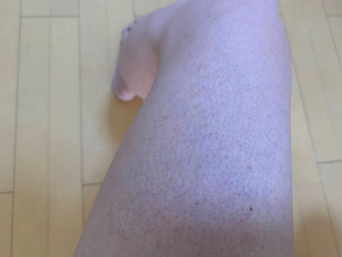 男の全身脱毛効果