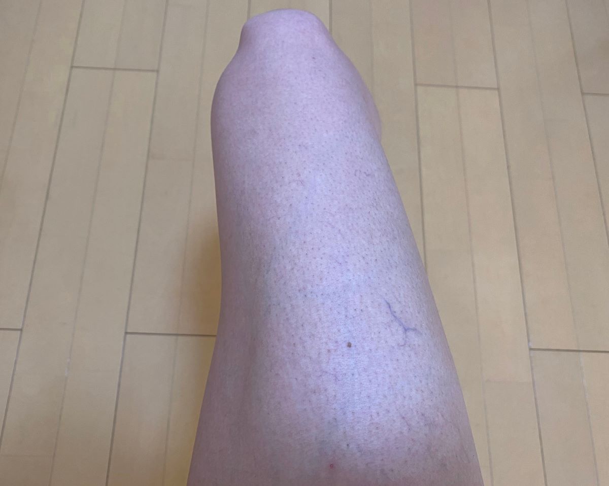 男の全身脱毛効果