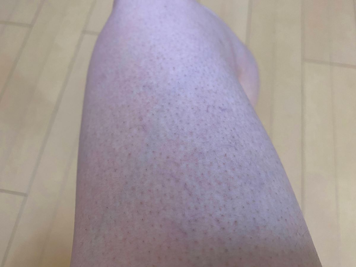 男の全身脱毛効果