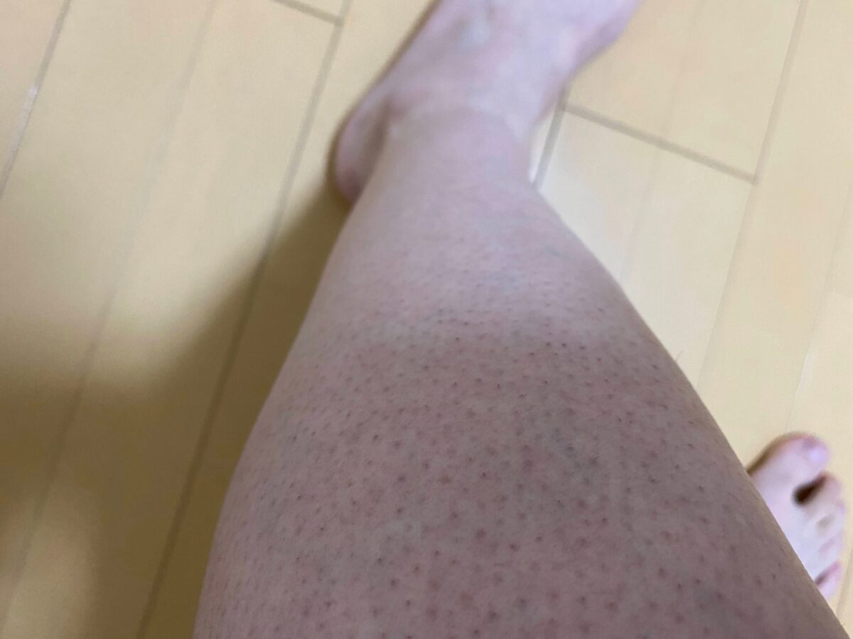 男の全身脱毛効果