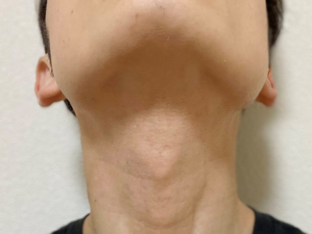 ヒゲ脱毛23回目の効果