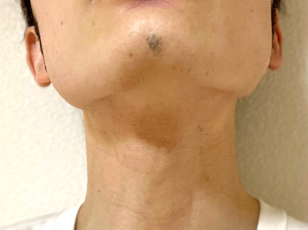 ヒゲ脱毛23回目の効果