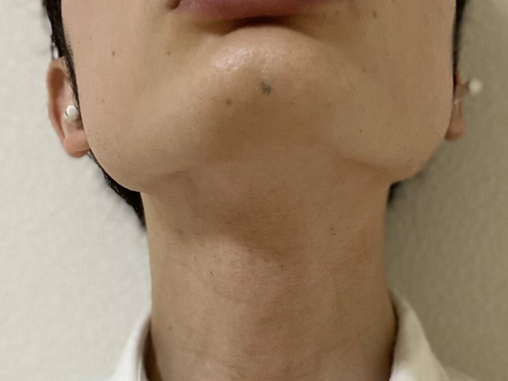 ヒゲ脱毛24回目の効果