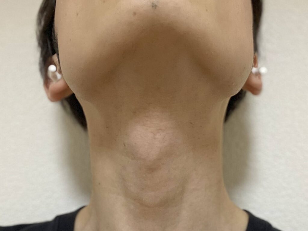 ヒゲ脱毛24回目の効果