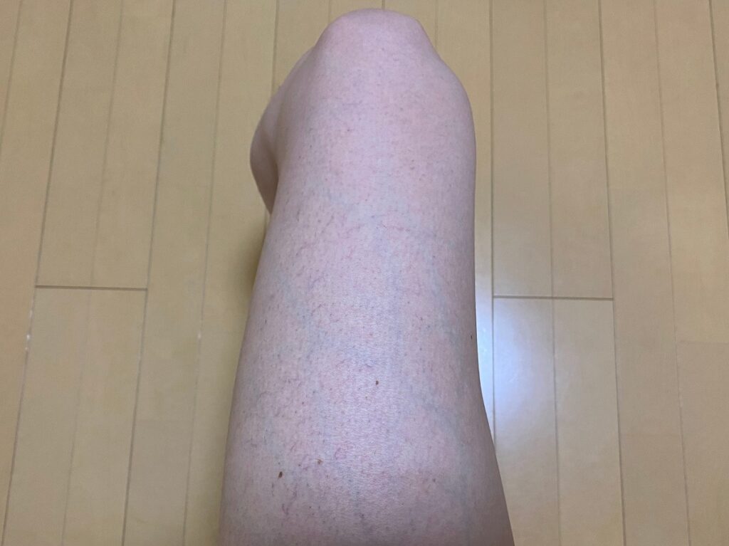 男の全身脱毛5回目の効果