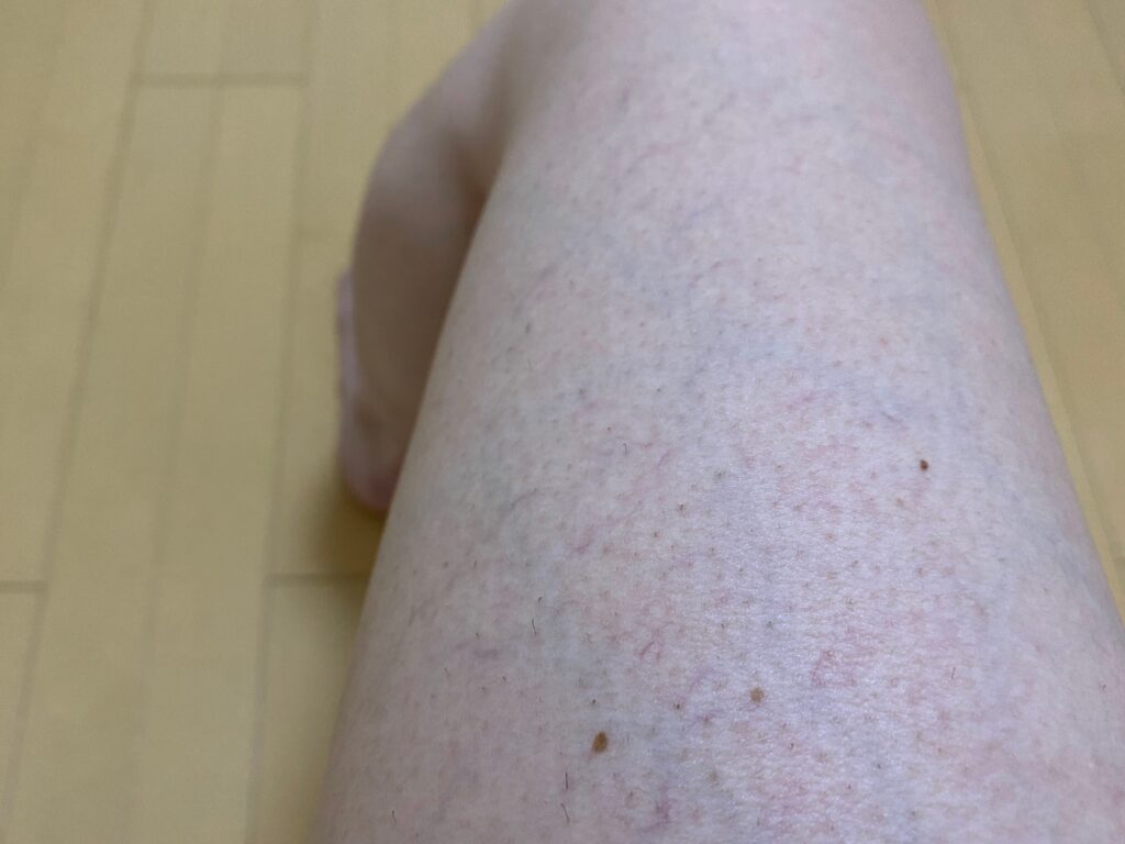 男の全身脱毛5回目の効果