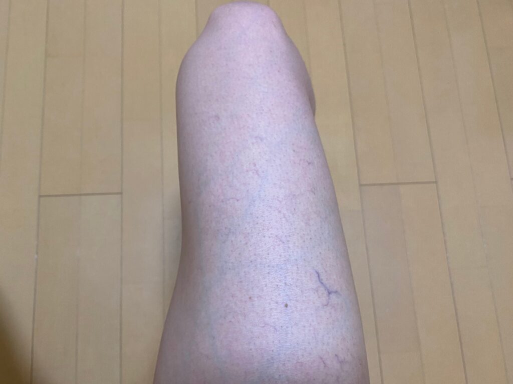 男の全身脱毛5回目の効果